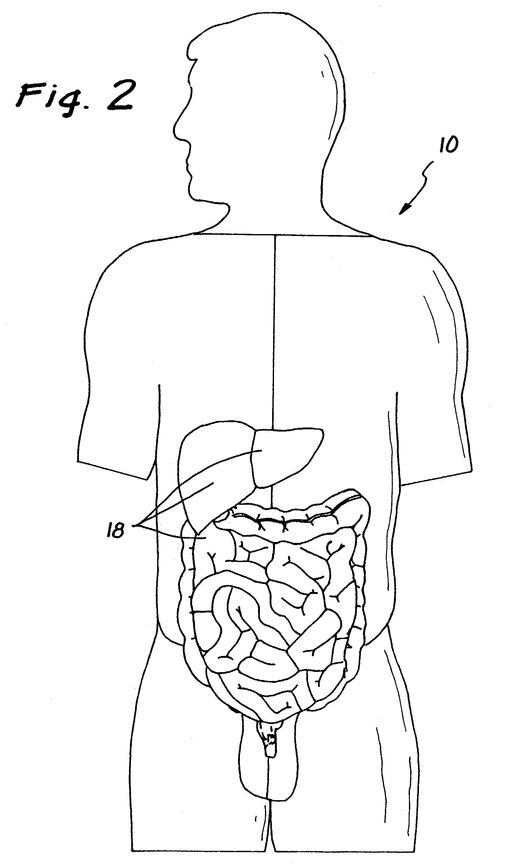 Surgical access apparatus and method