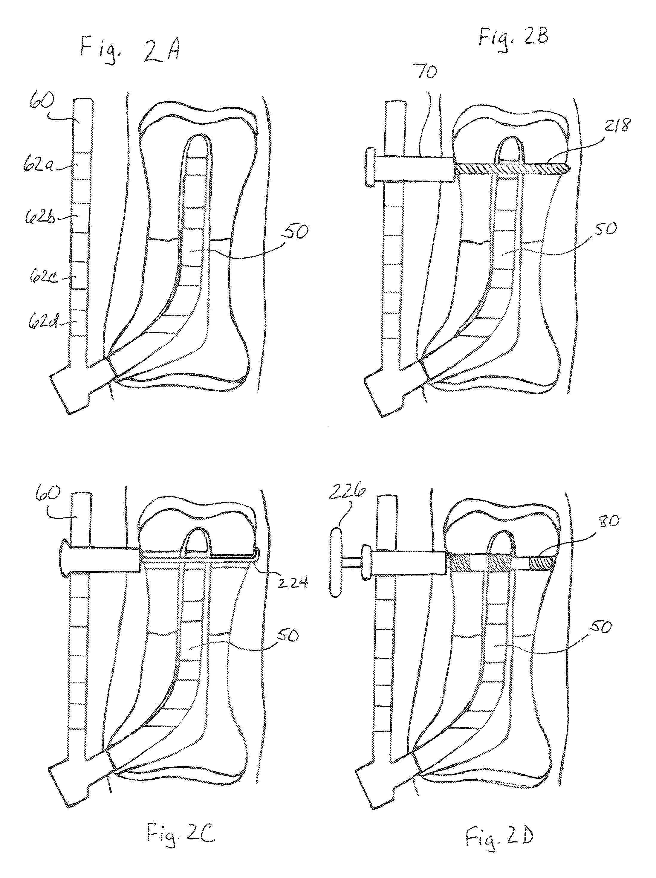 Intramedullary rod fixation system