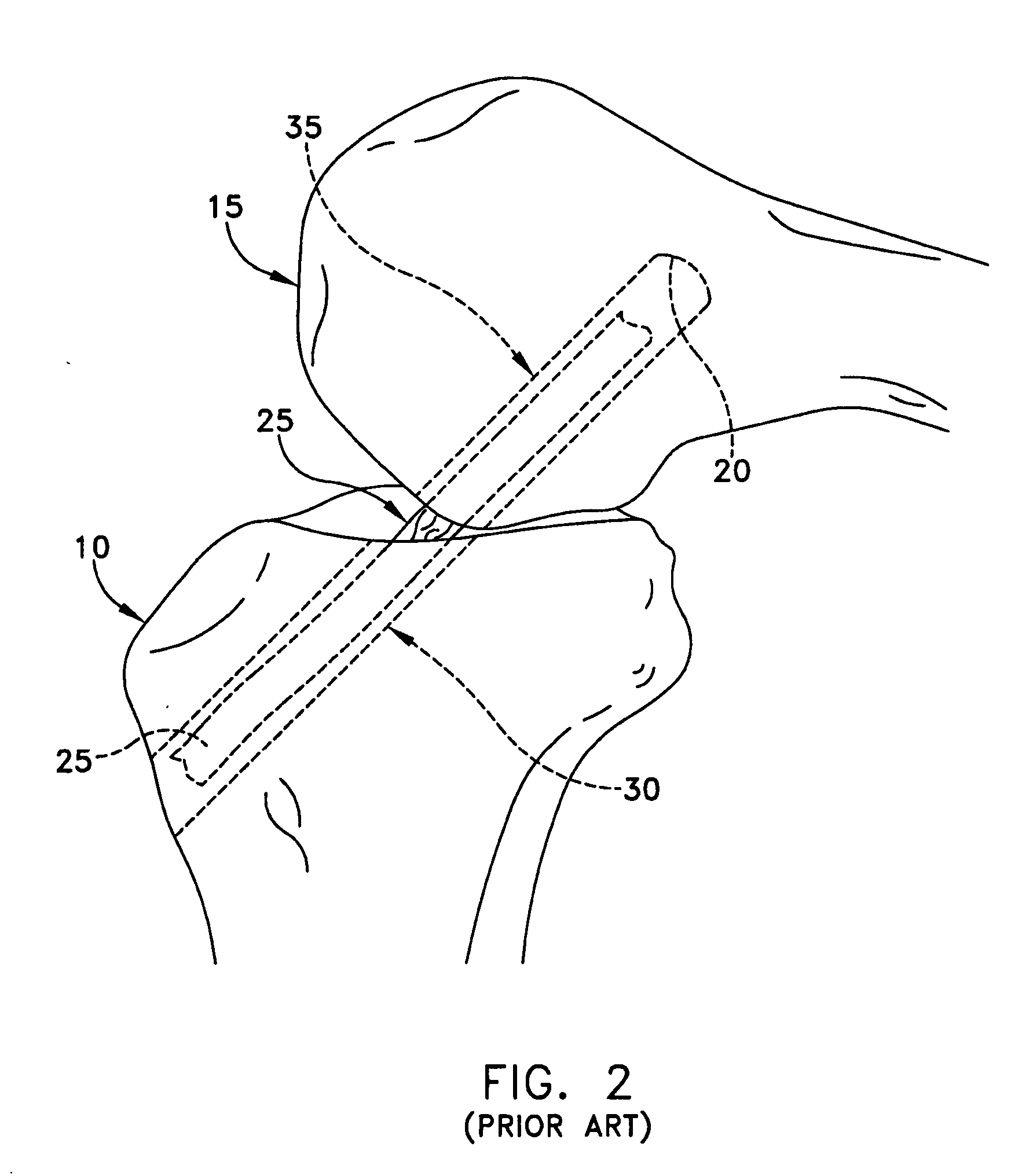 Method and apparatus for reconstructing a ligament