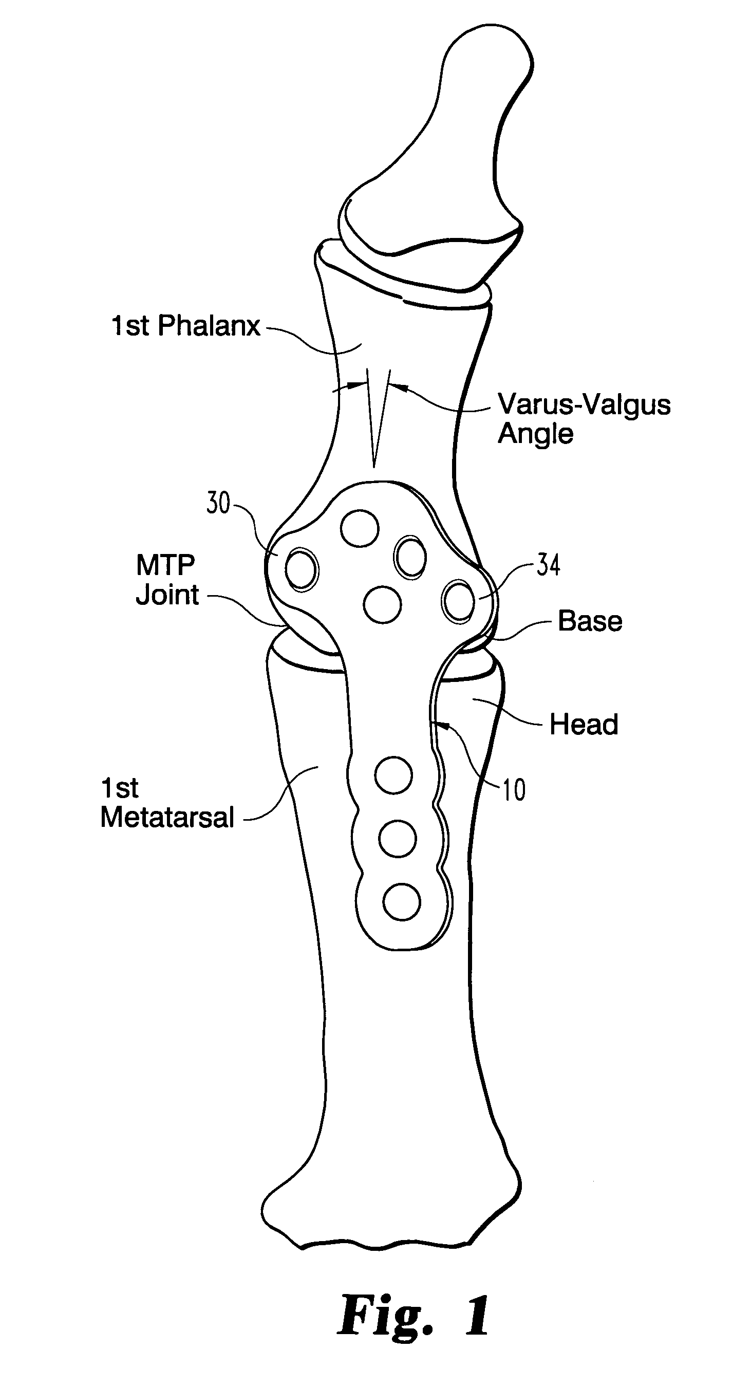 Plate for fusion of the metatarso-phalangeal joint