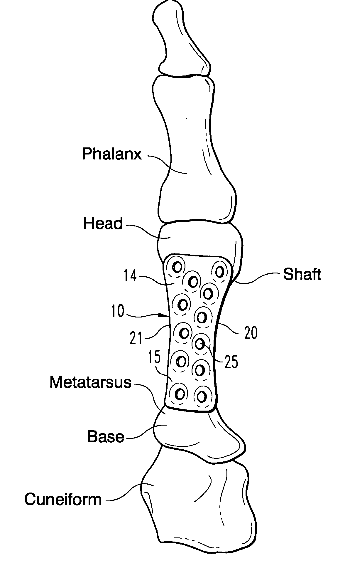 Metatarsal fixation plate