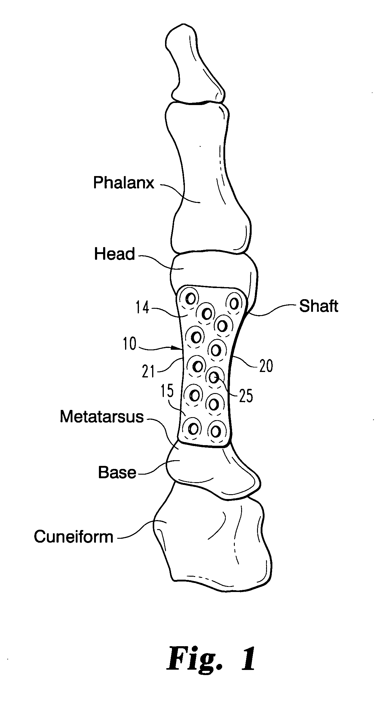 Metatarsal fixation plate