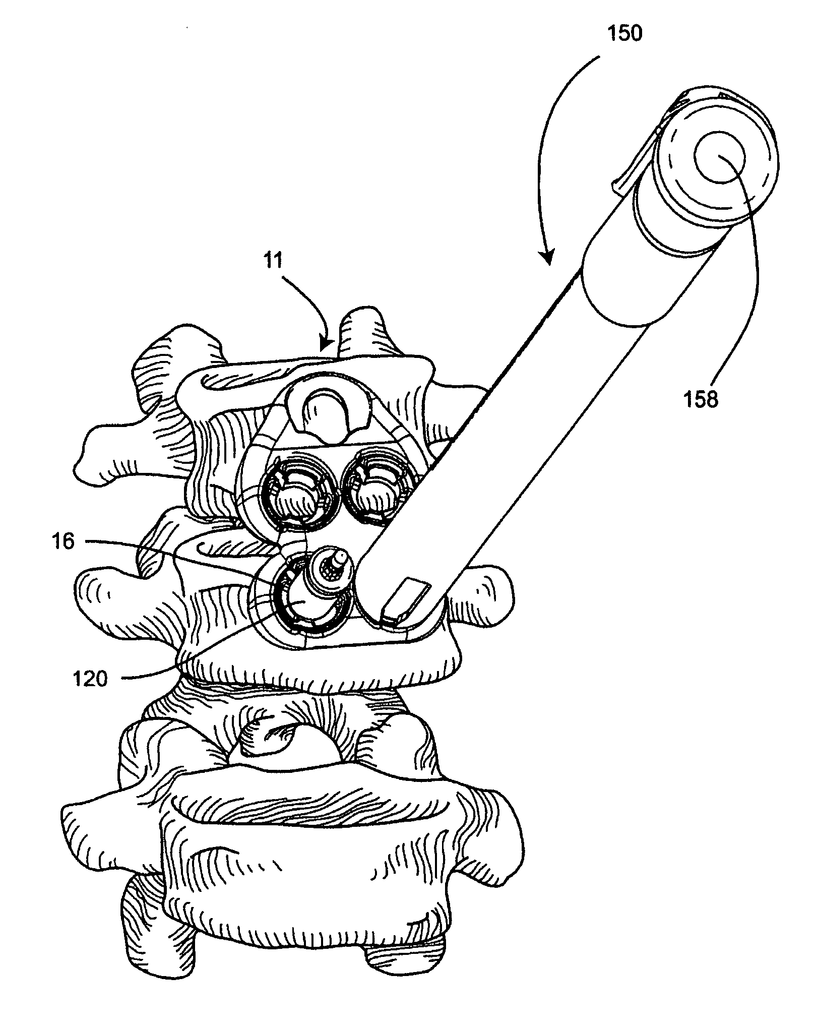 System and method for vertebral body plating