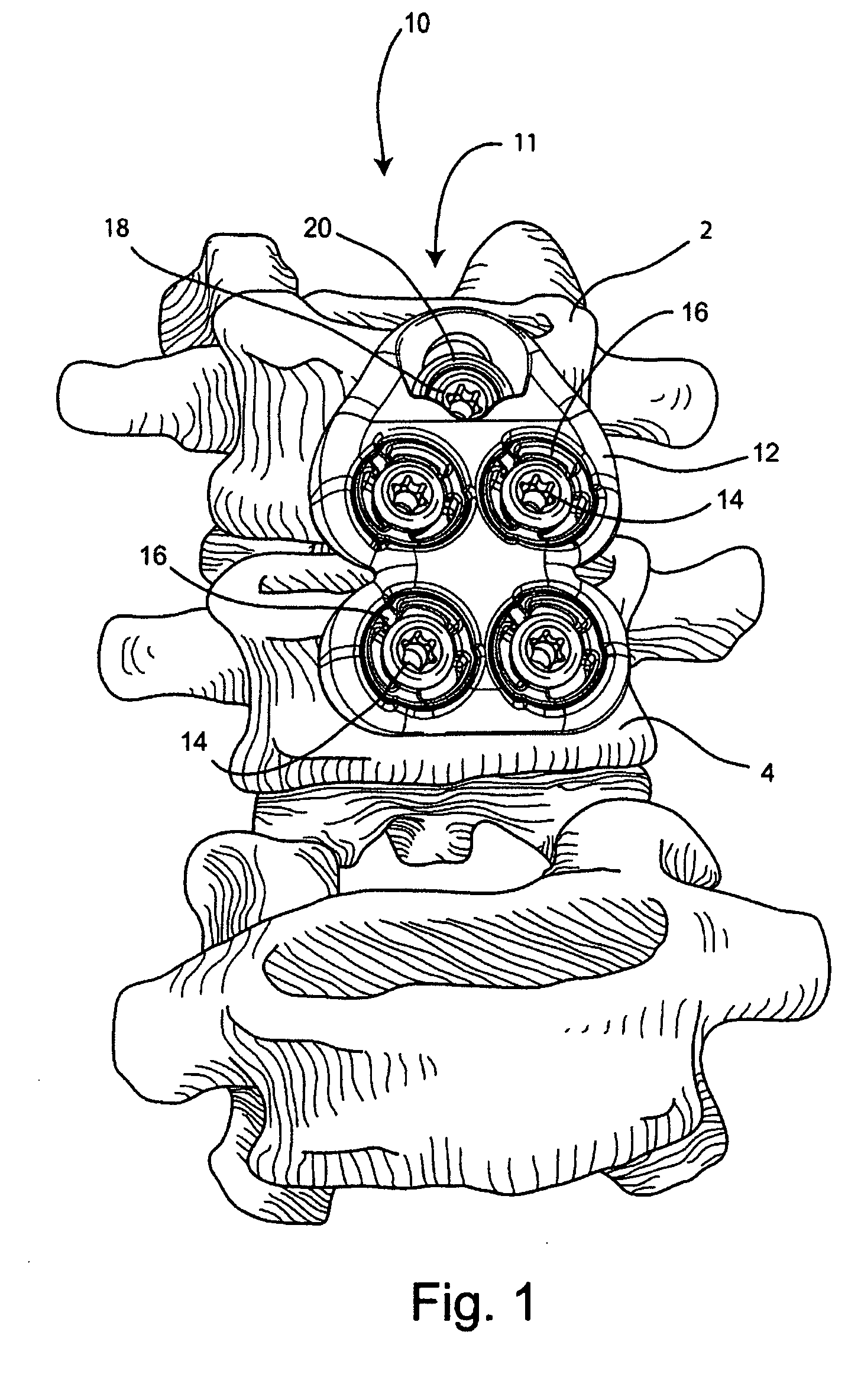 System and method for vertebral body plating