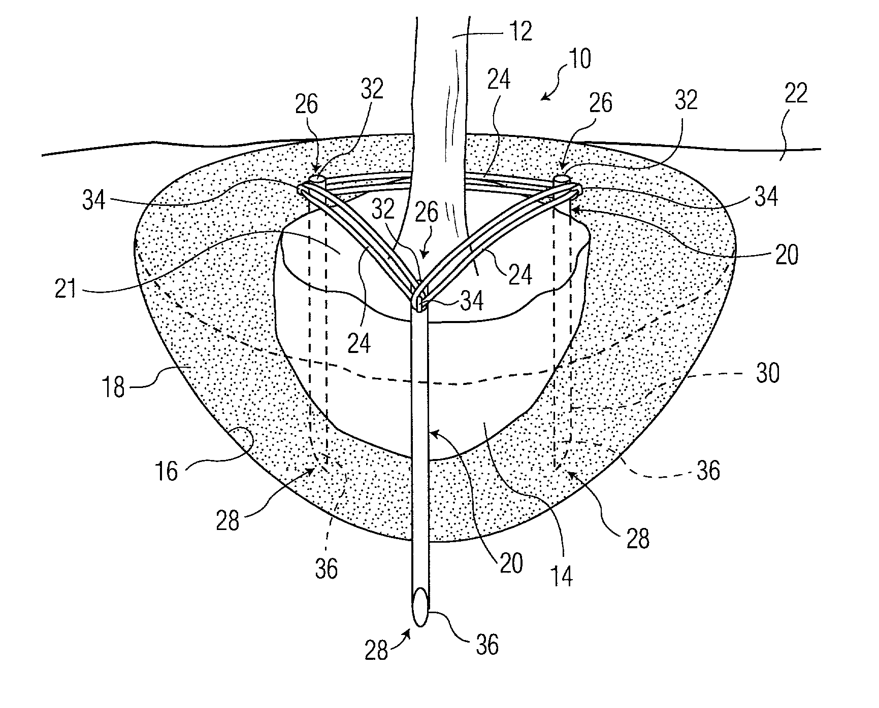 Tree and shrub stabilizing apparatus and method for stabilizing a tree or shrub