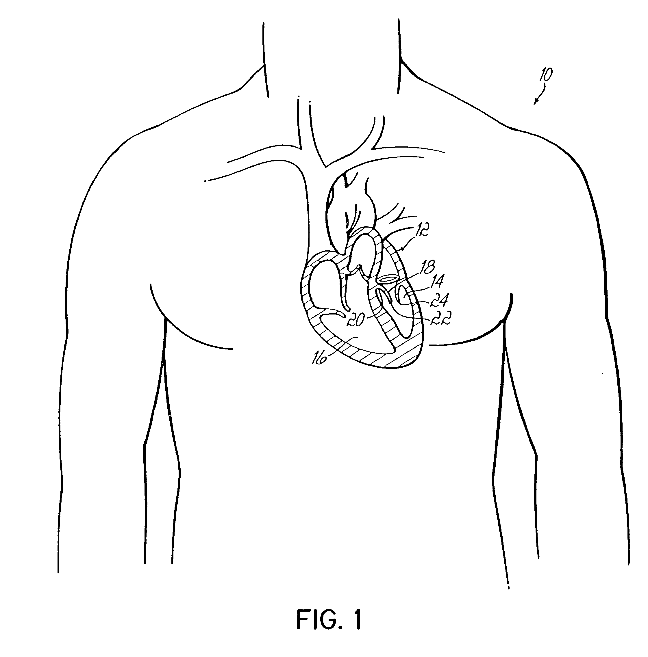 Annuloplasty devices and related heart valve repair methods