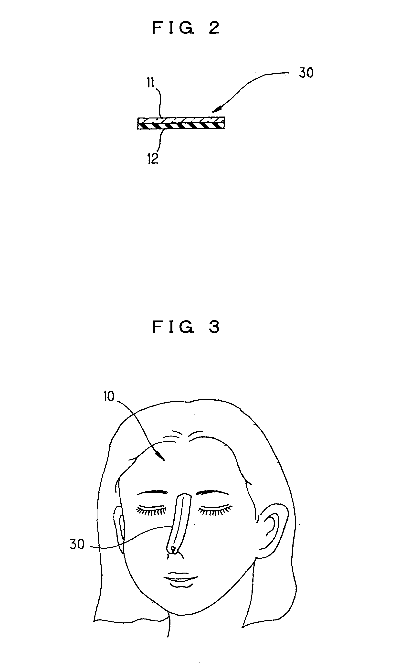 Nose ridge reshaping device