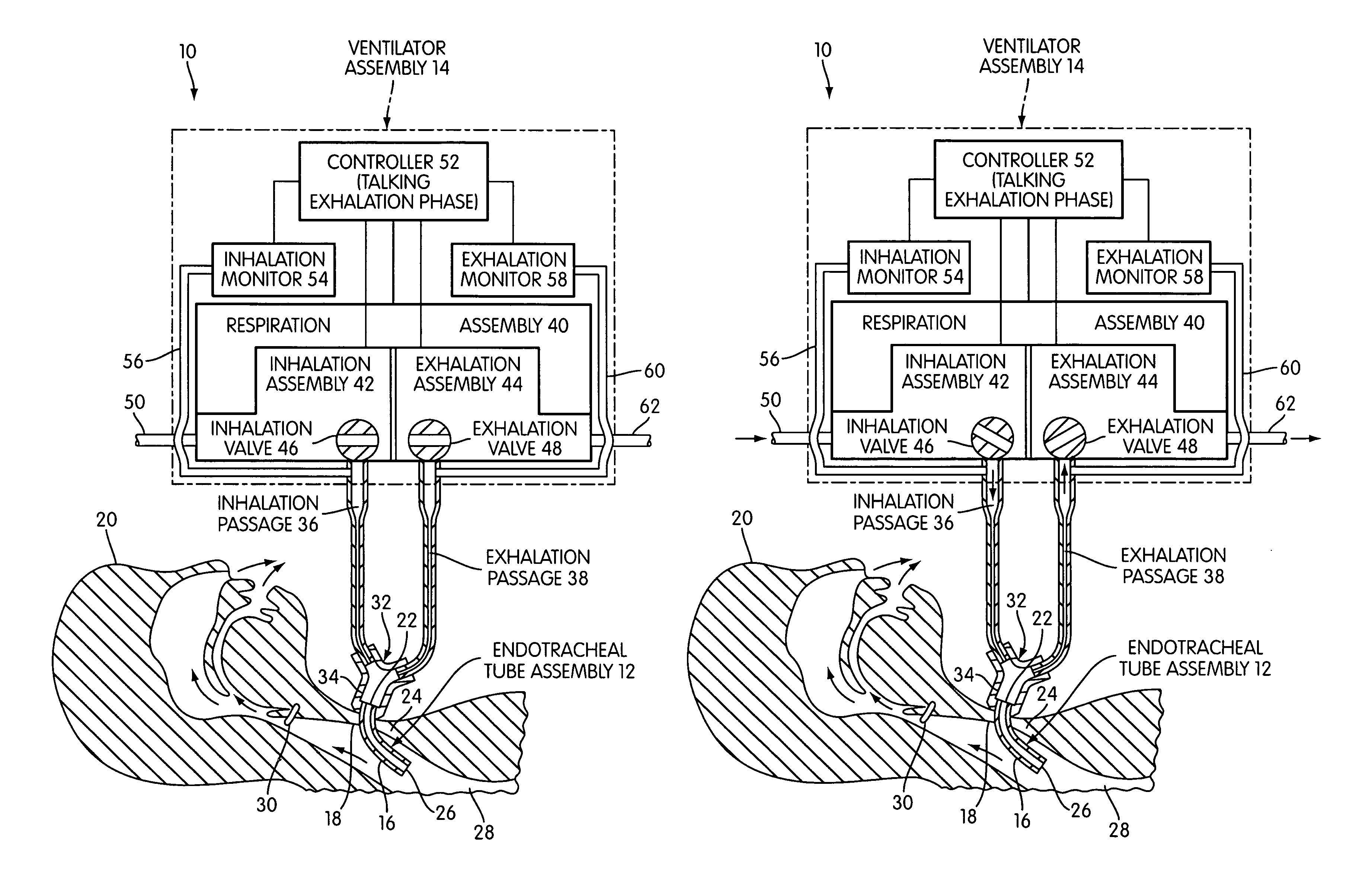 Ventilating apparatus and method enabling a patient to talk with or without a trachostomy tube check valve