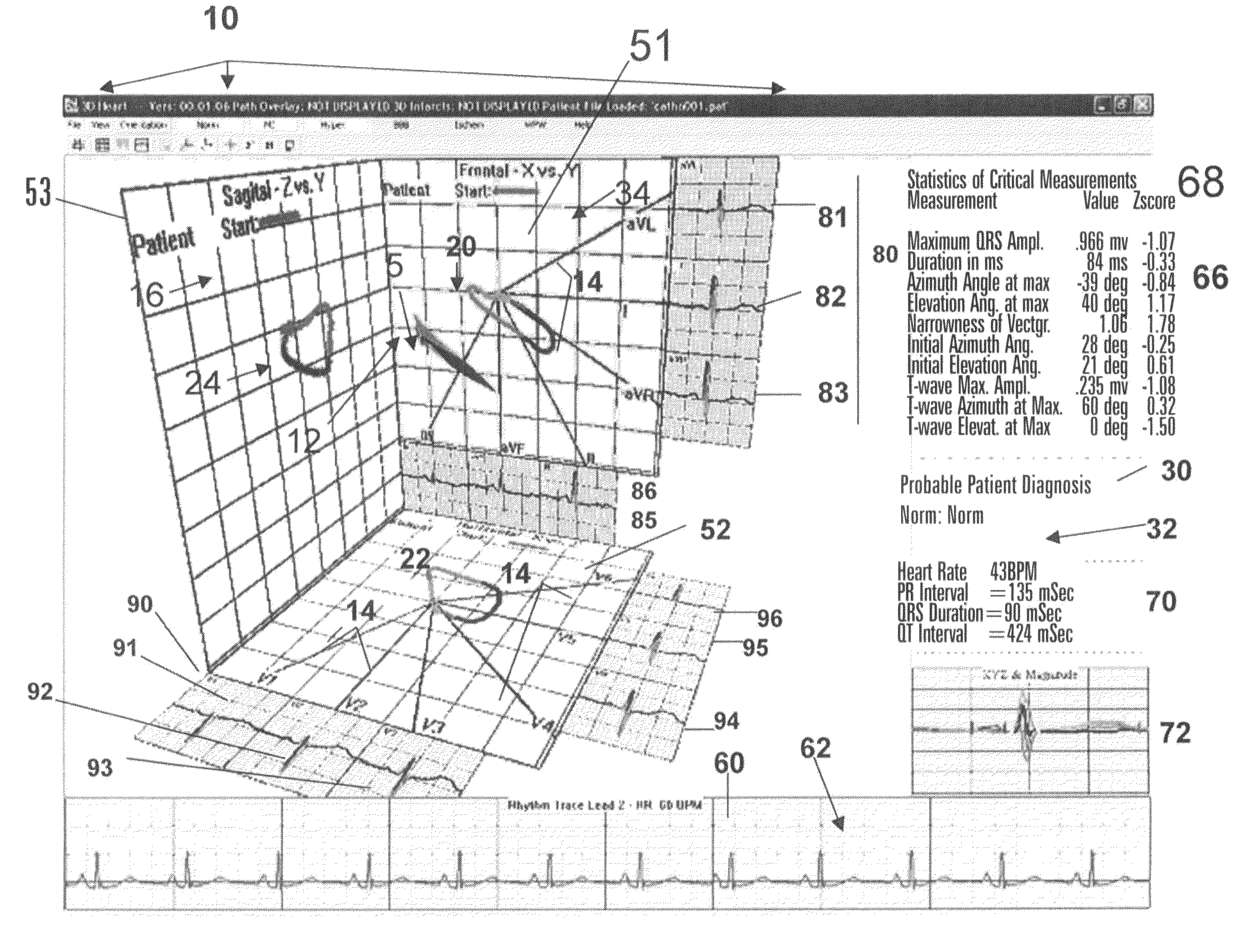 Location and displaying an ischemic region for ECG diagnostics