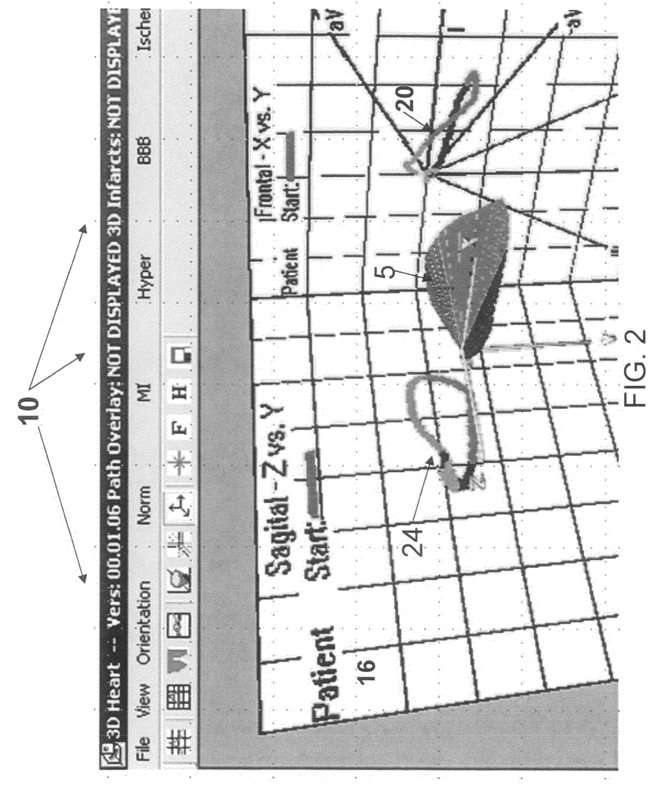 Location and displaying an ischemic region for ECG diagnostics