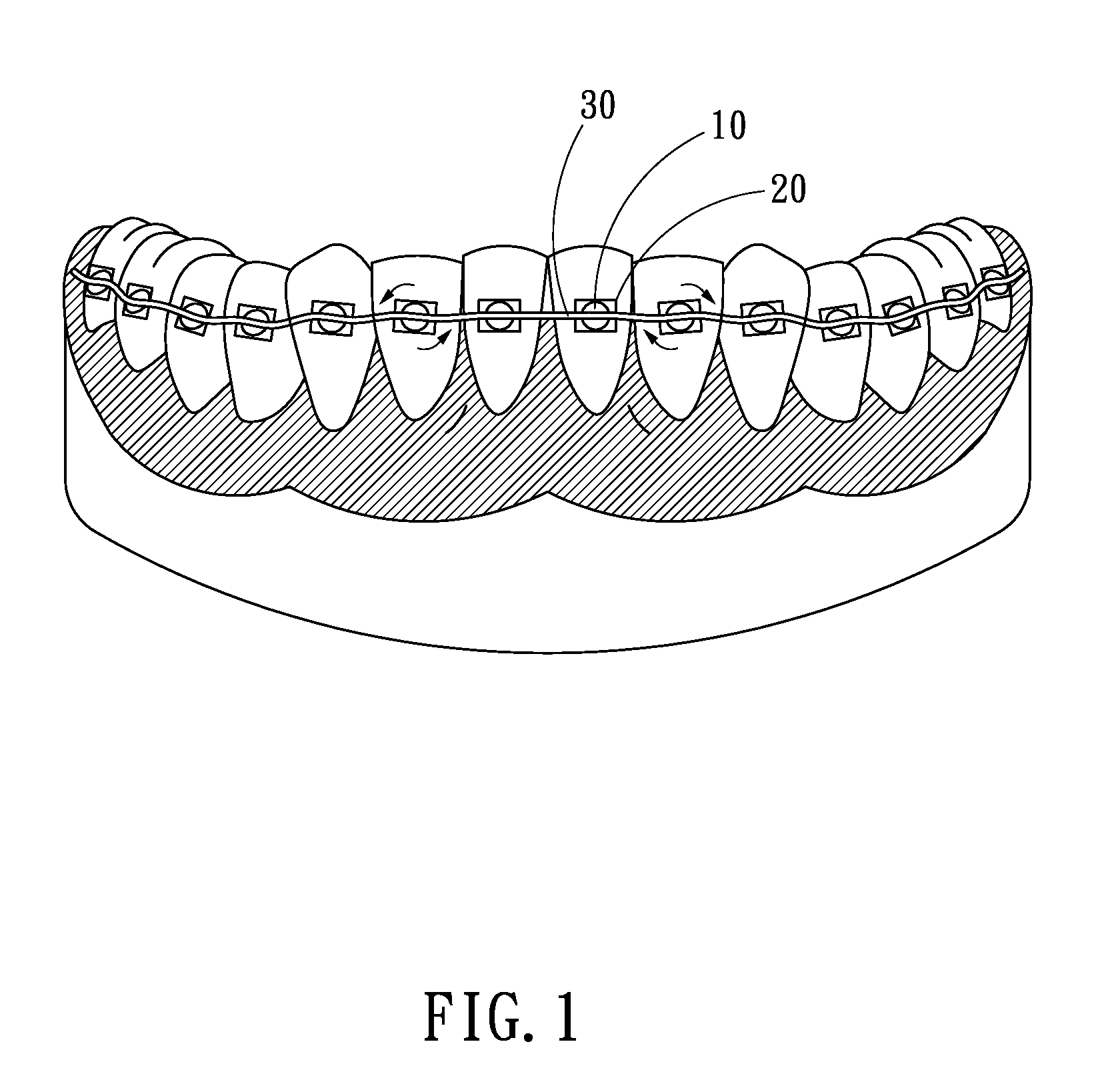 Adjustable orthodontic bracket