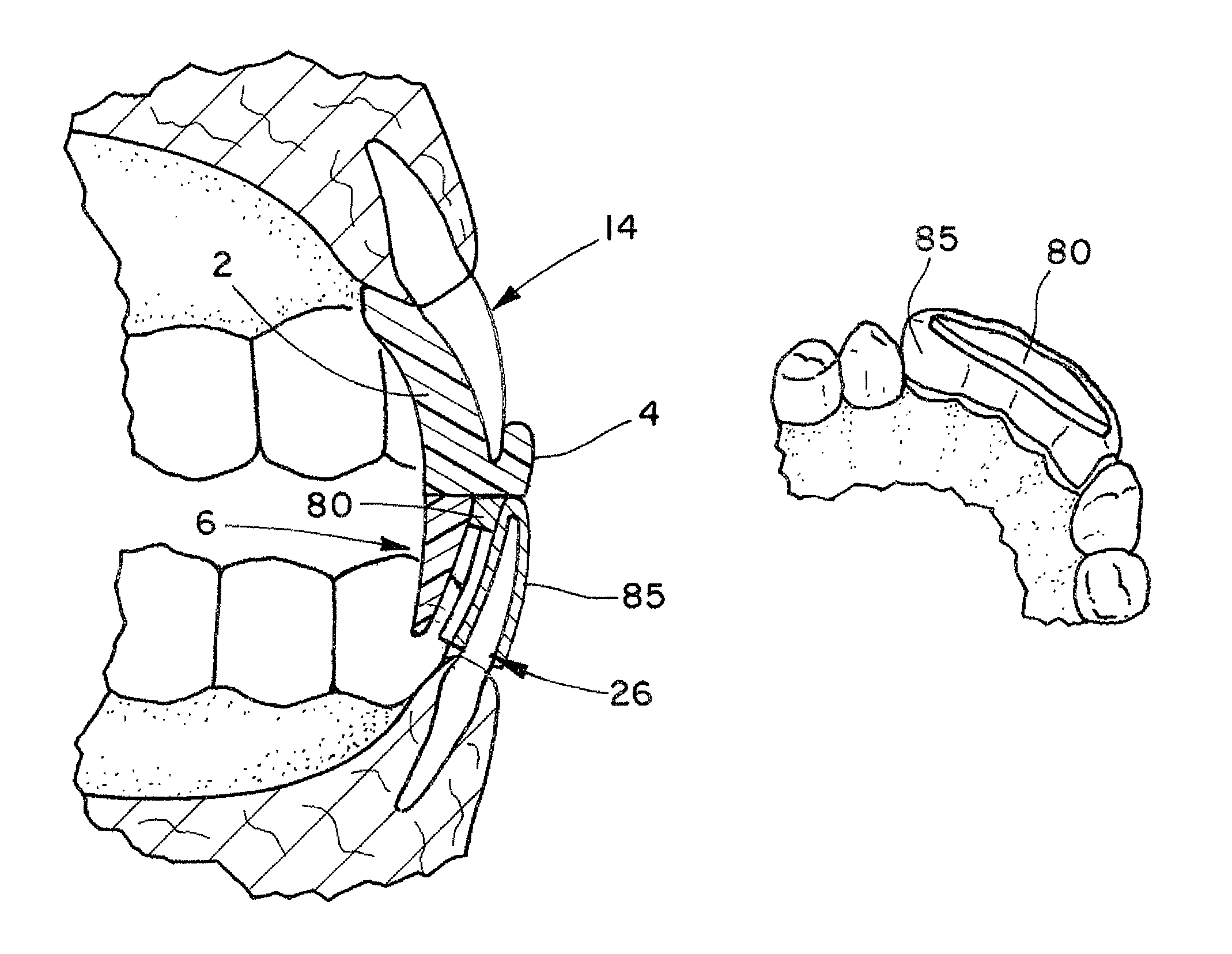 Intraoral mandibular advancement device for treatment of sleep disorders