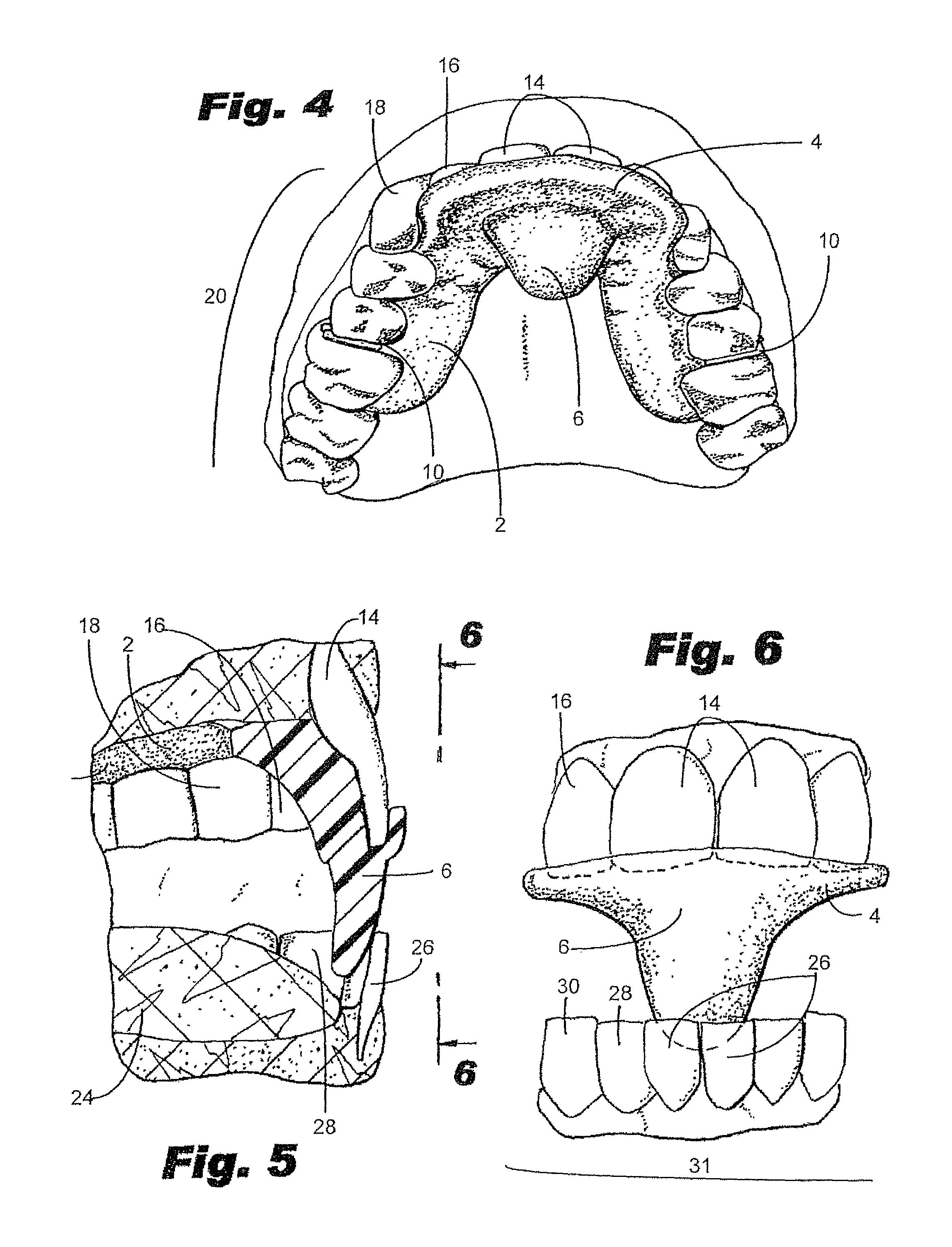 Intraoral mandibular advancement device for treatment of sleep disorders