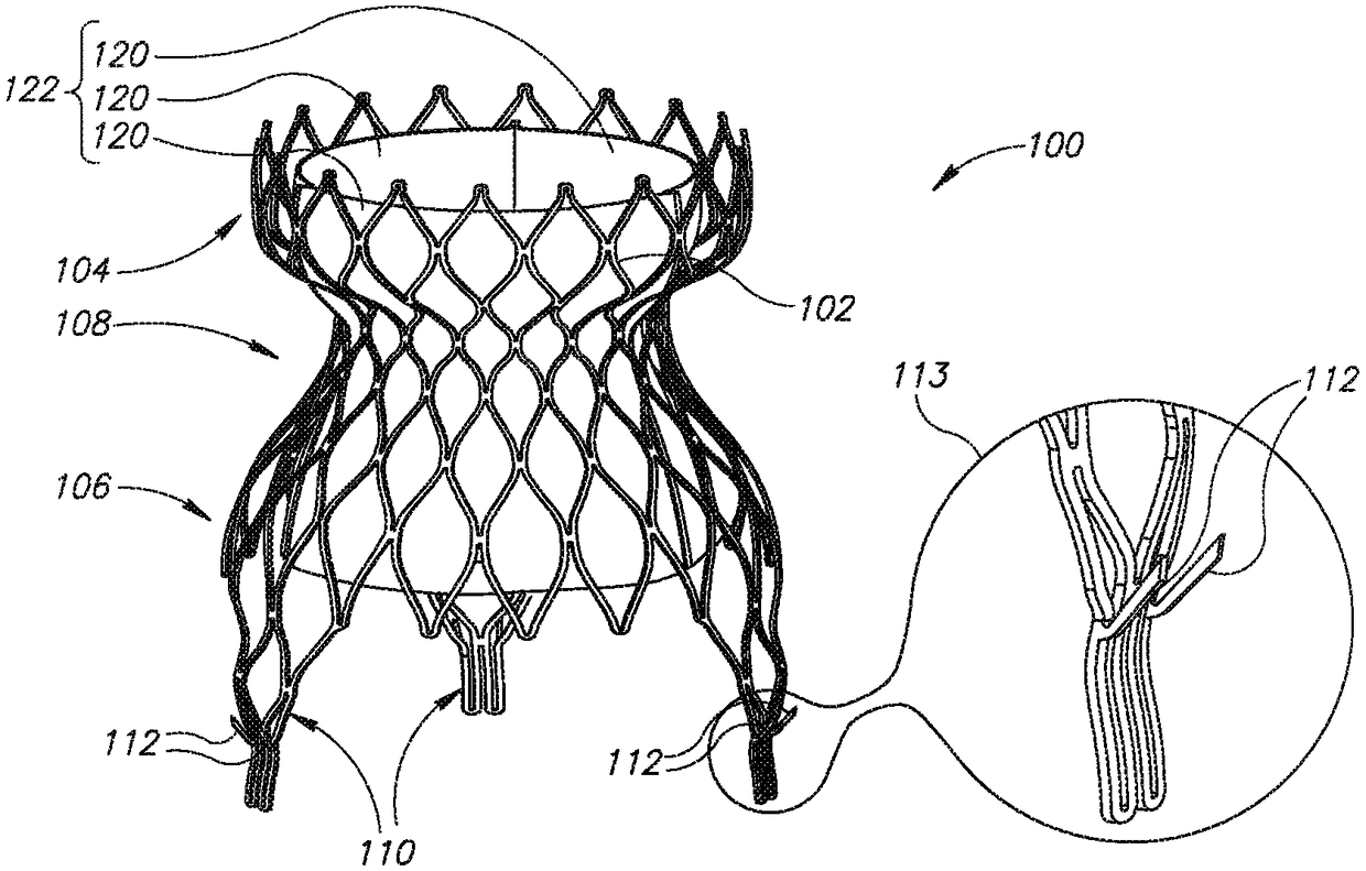 Cardiac Prosthesis and Its Deployment