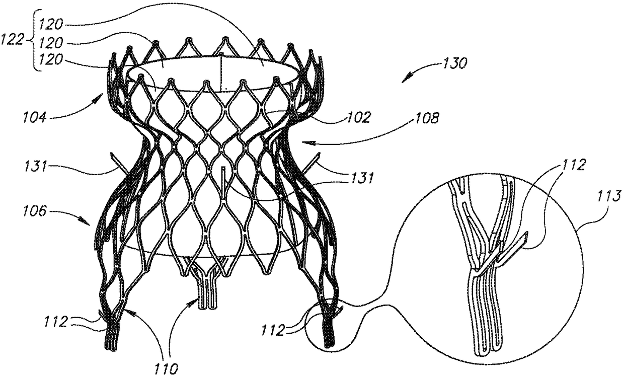 Cardiac Prosthesis and Its Deployment