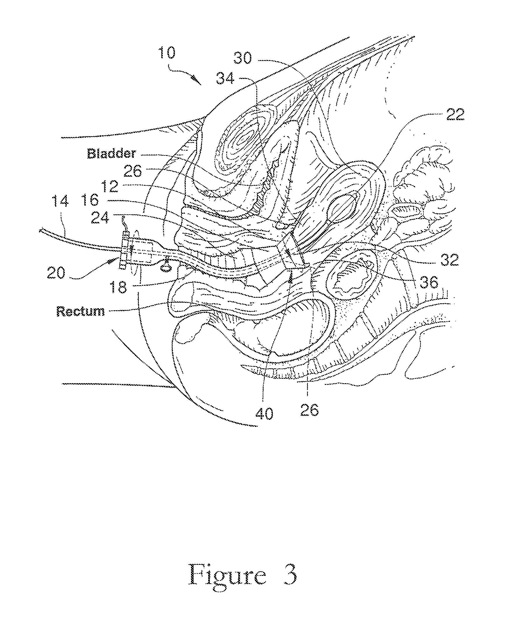 Electrosurgical element and uterine manipulator for total laparoscopic hysterectomy