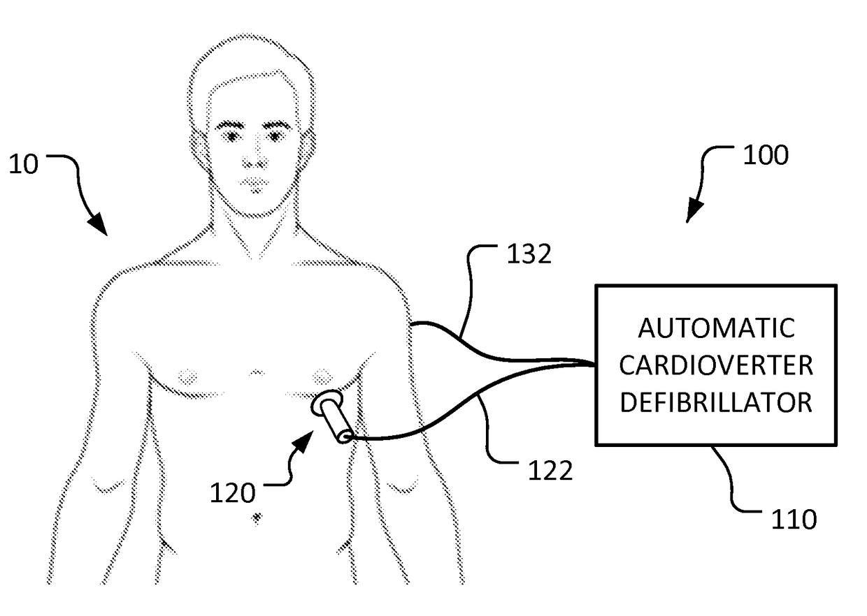 Percutaneous temporary epicardial pacemaker system