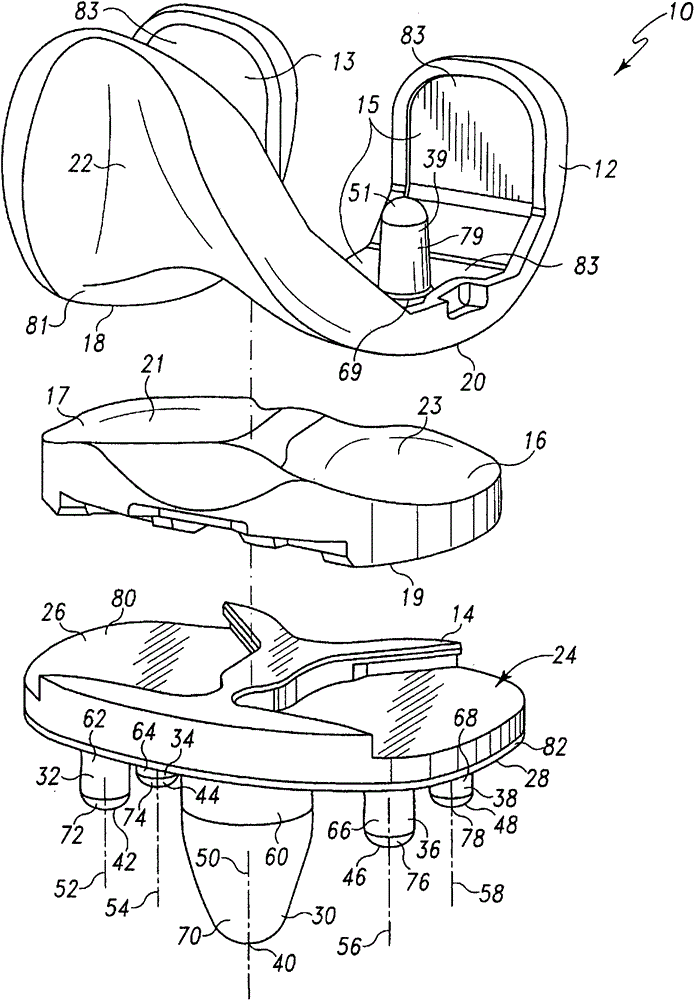 Prosthesis for bone cementless fixation and its preparation method