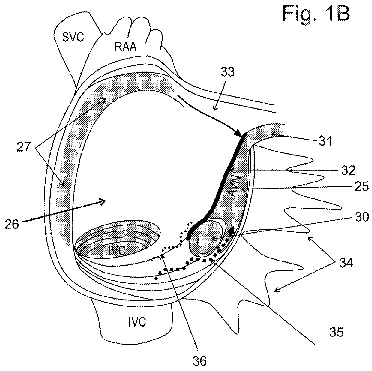 Cardiac stimulation of atrial-ventricle pathways and/or associated tissue