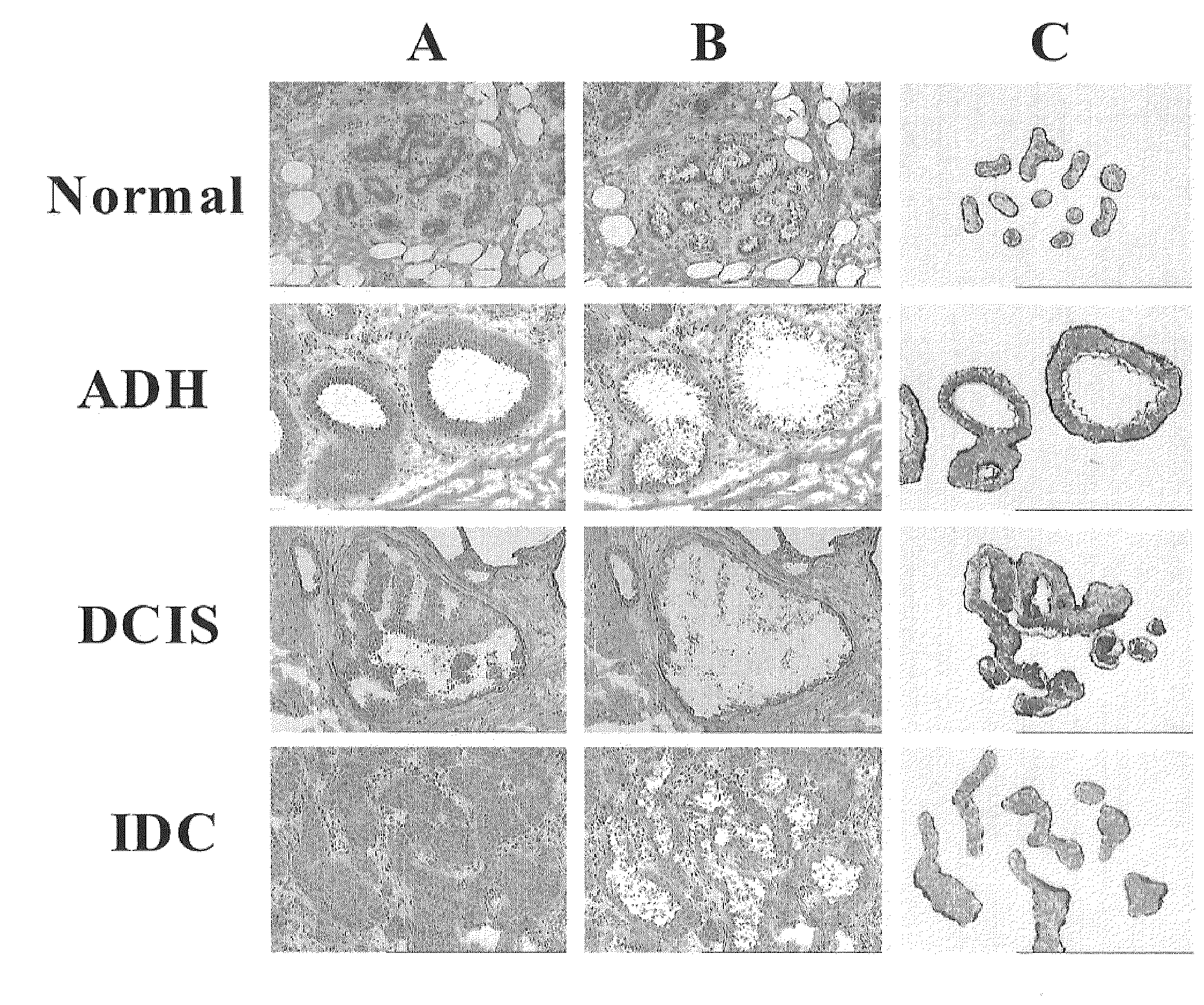 Grading of breast cancer