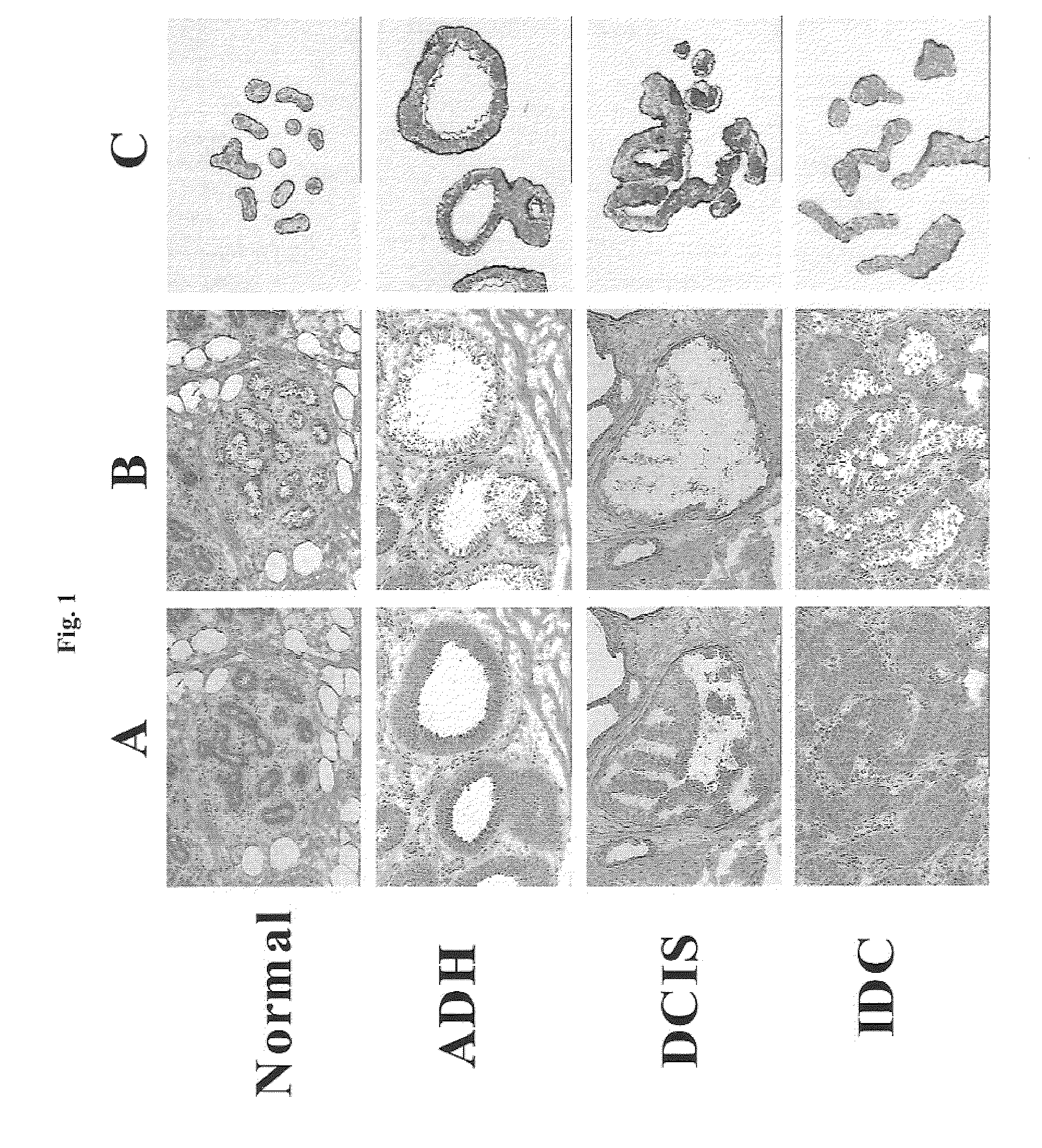 Grading of breast cancer