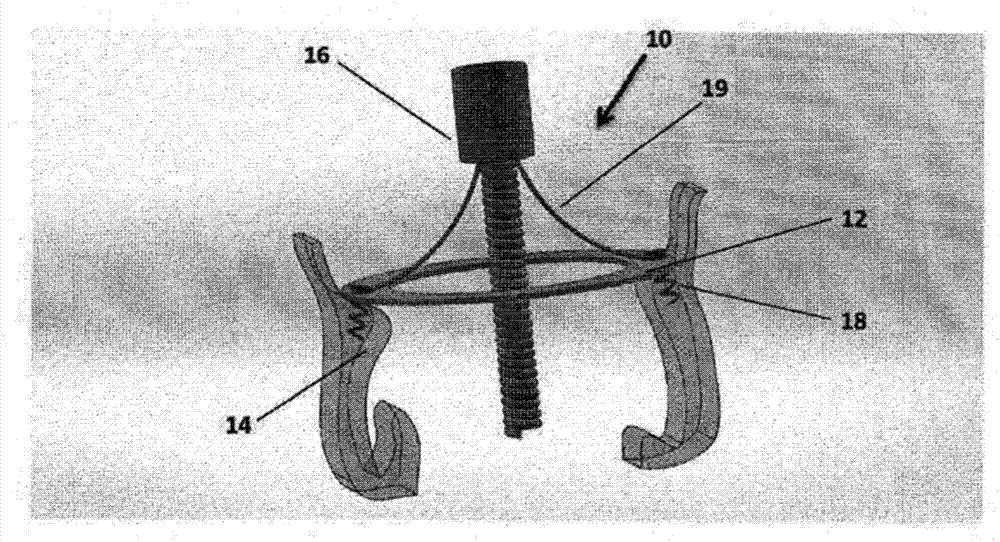 Single-ring cardiac valve support