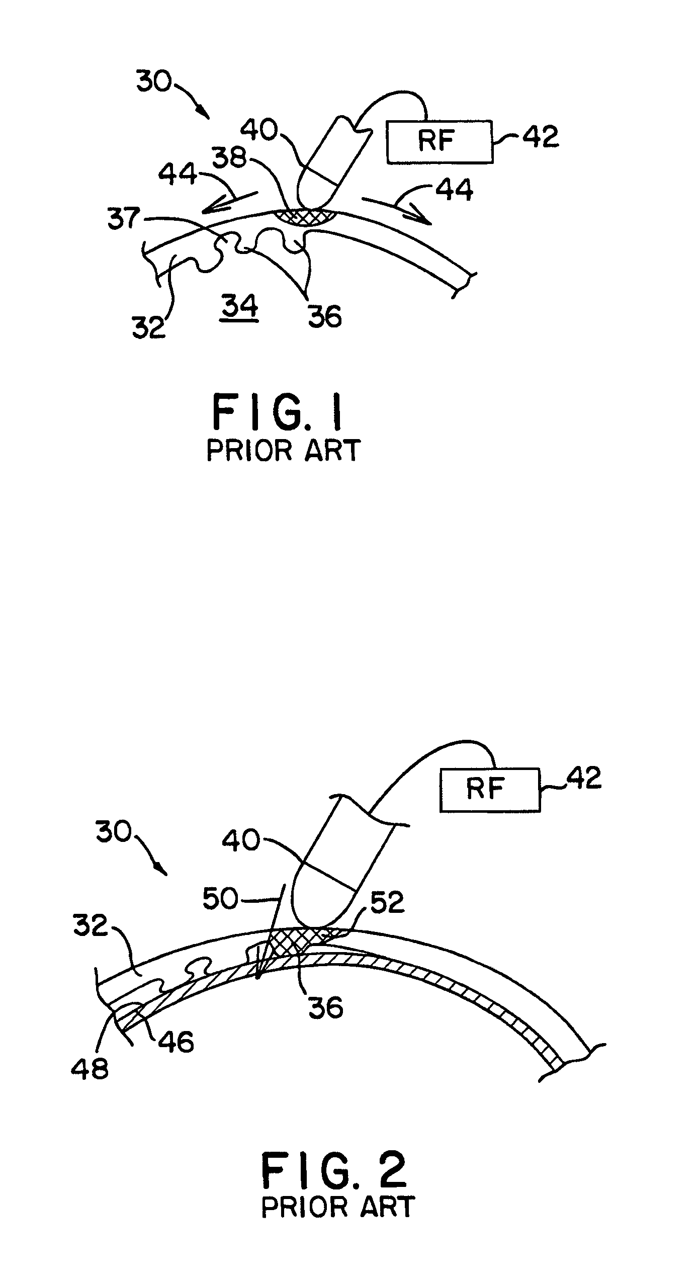 Endocardial dispersive electrode for use with a monopolar RF ablation pen