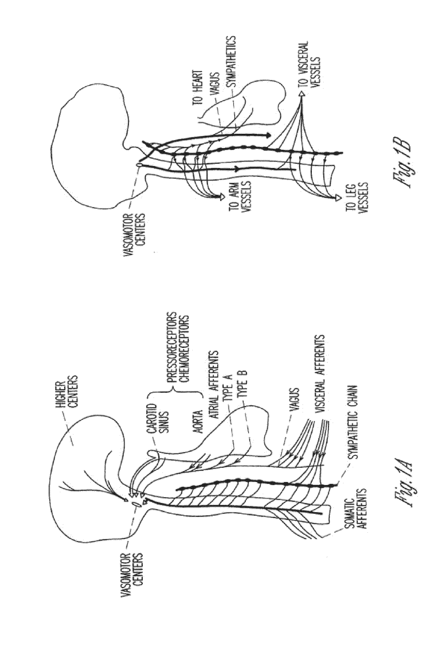 Adaptive baroreflex stimulation therapy for disordered breathing