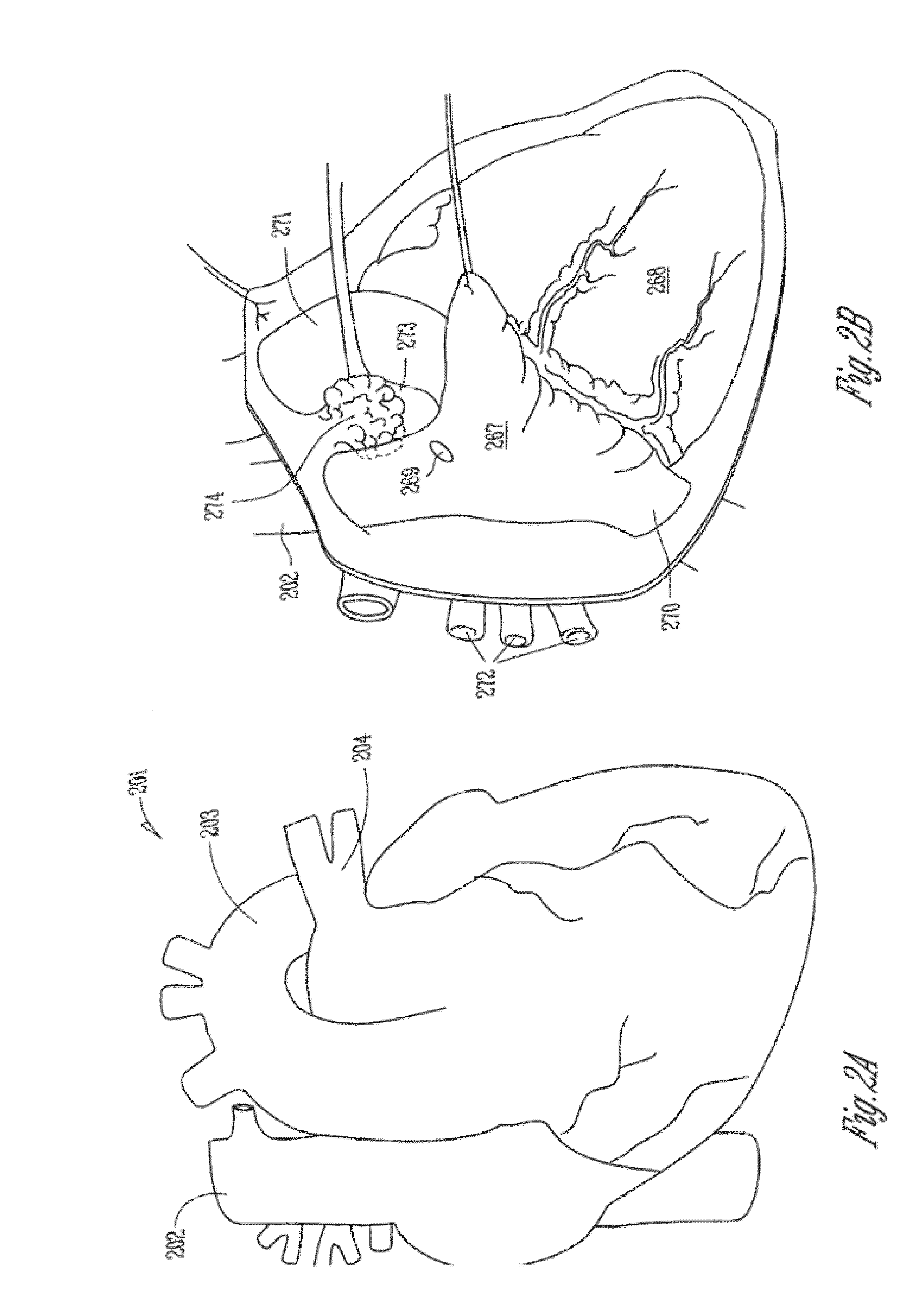 Adaptive baroreflex stimulation therapy for disordered breathing