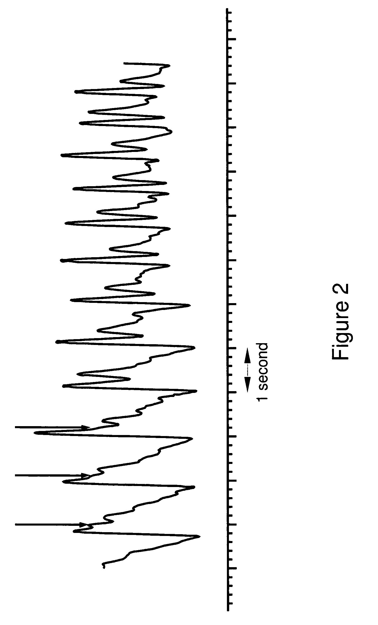 Arterial pulse decomposition analysis for vital signs determination