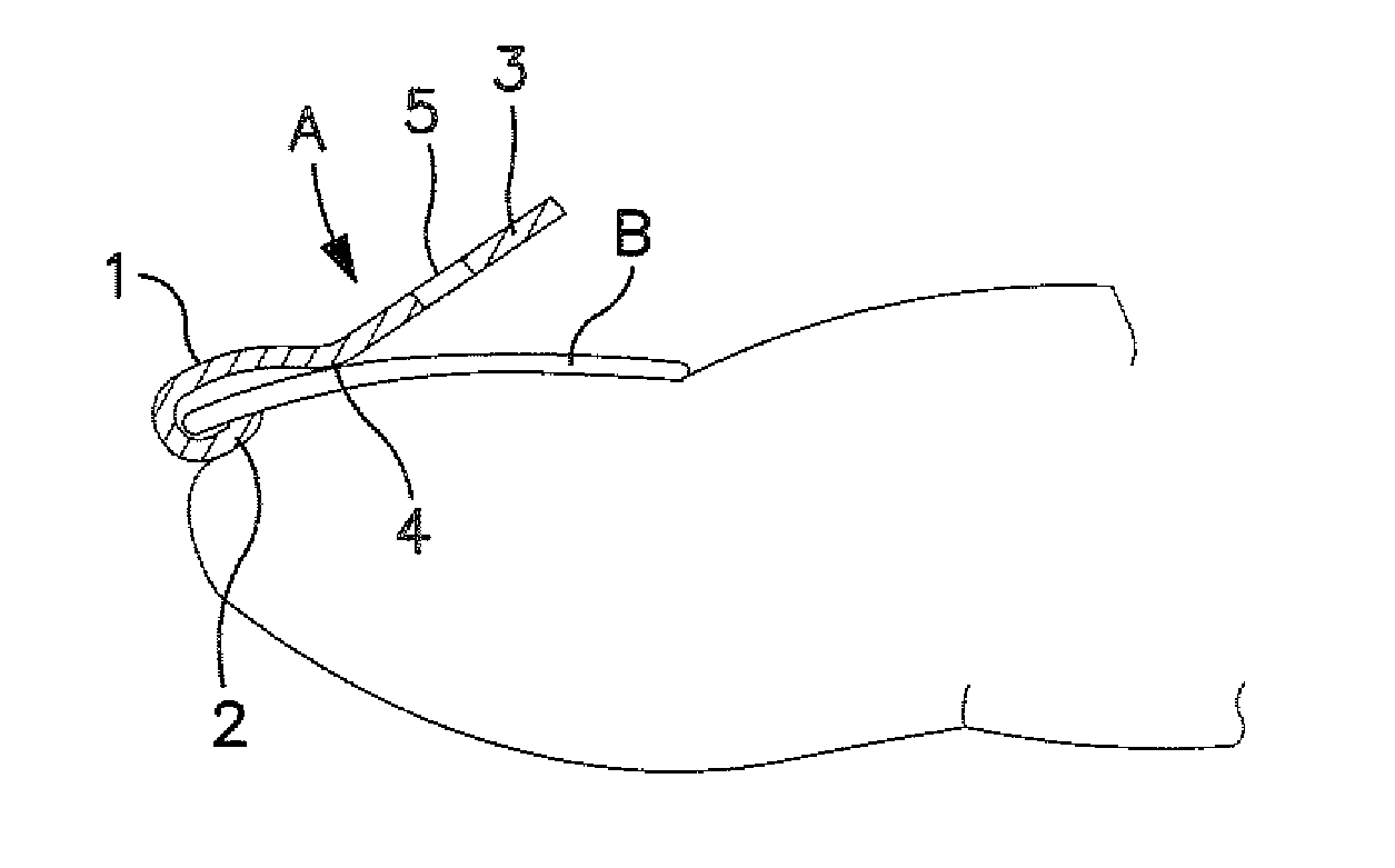 Ingrown nail correcting device