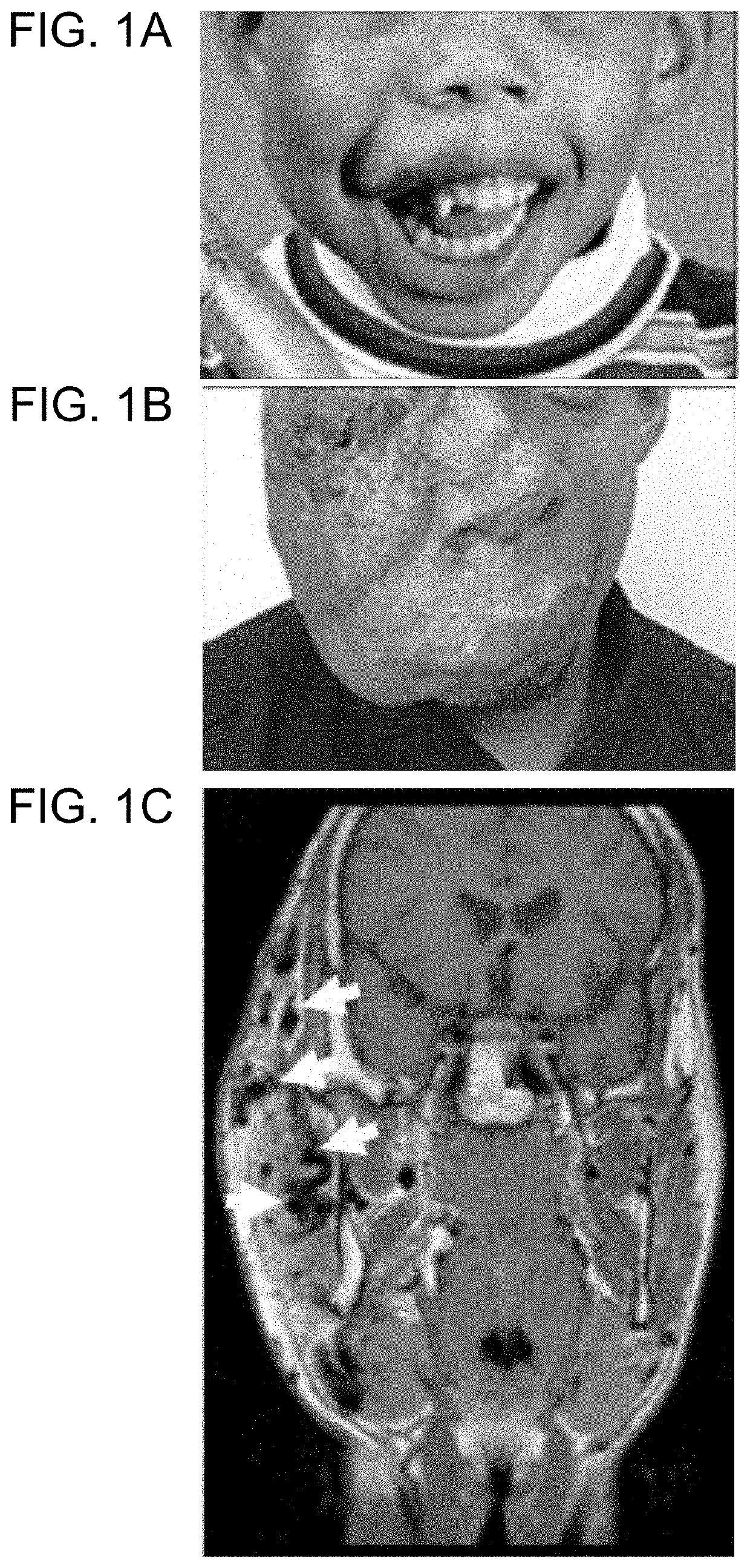 Map2k1 (MEK1) as a therapeutic target for arteriovenous malformations and associated disorders