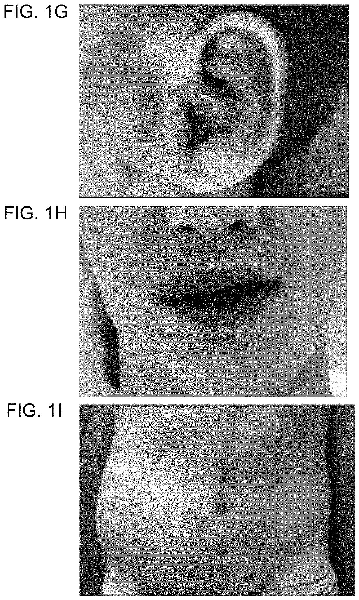 Map2k1 (MEK1) as a therapeutic target for arteriovenous malformations and associated disorders