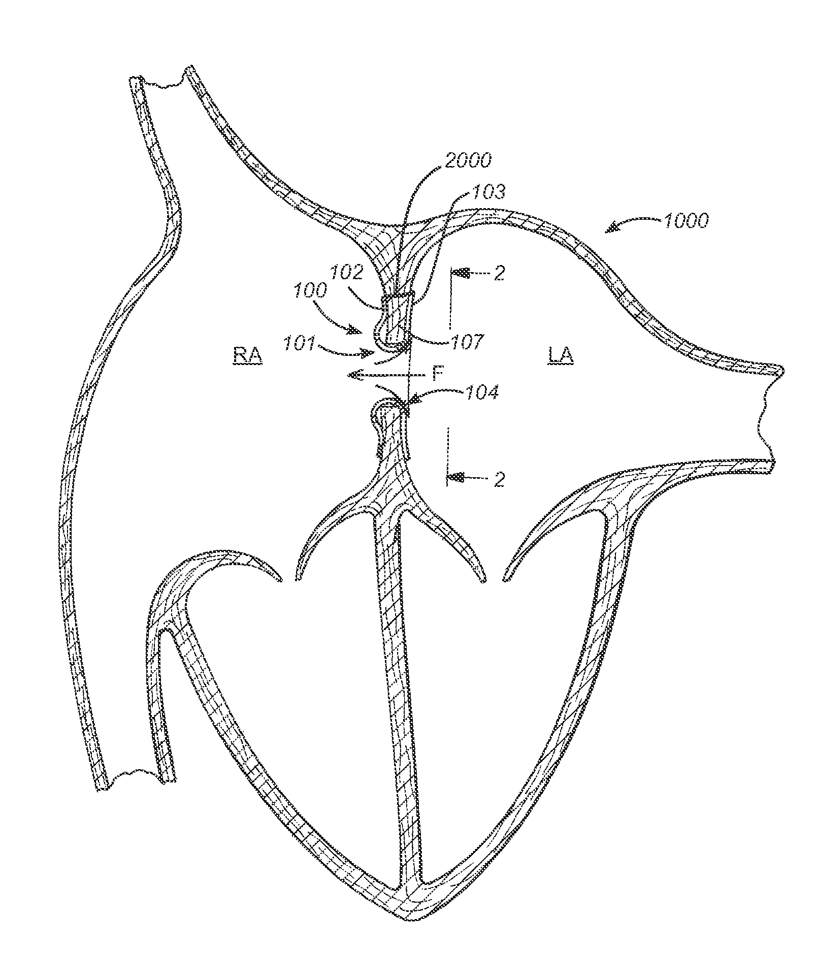 Prosthesis for reducing intra-cardiac pressure having an embolic filter