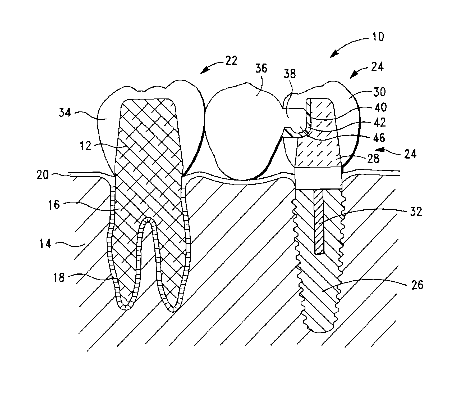 Dental bridge