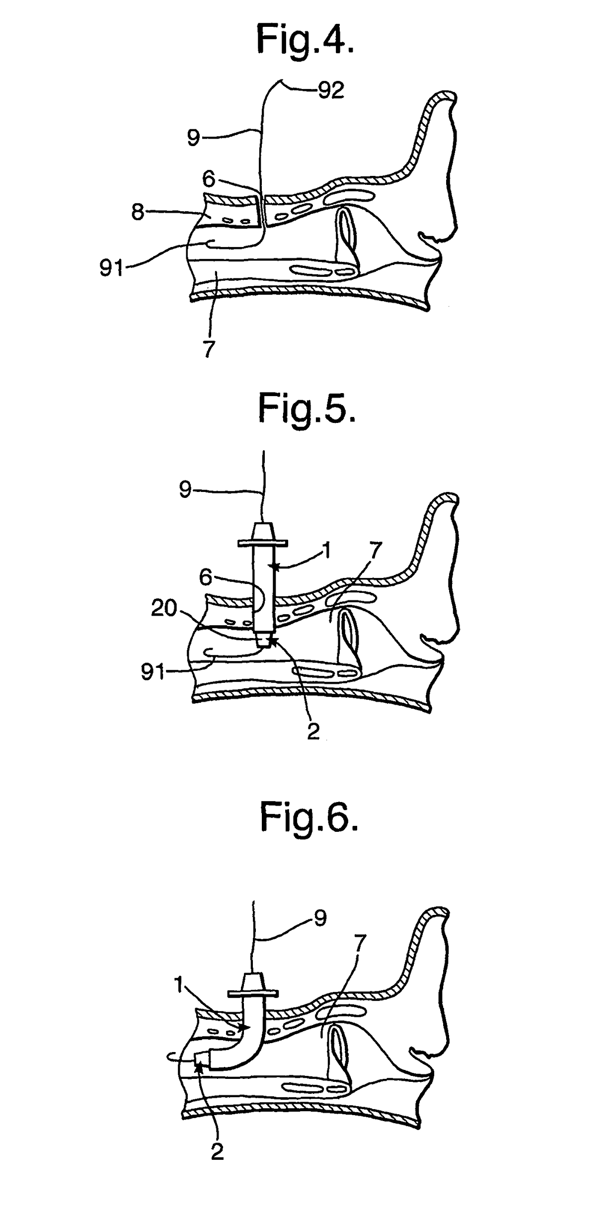 Tracheostomy tube assemblies