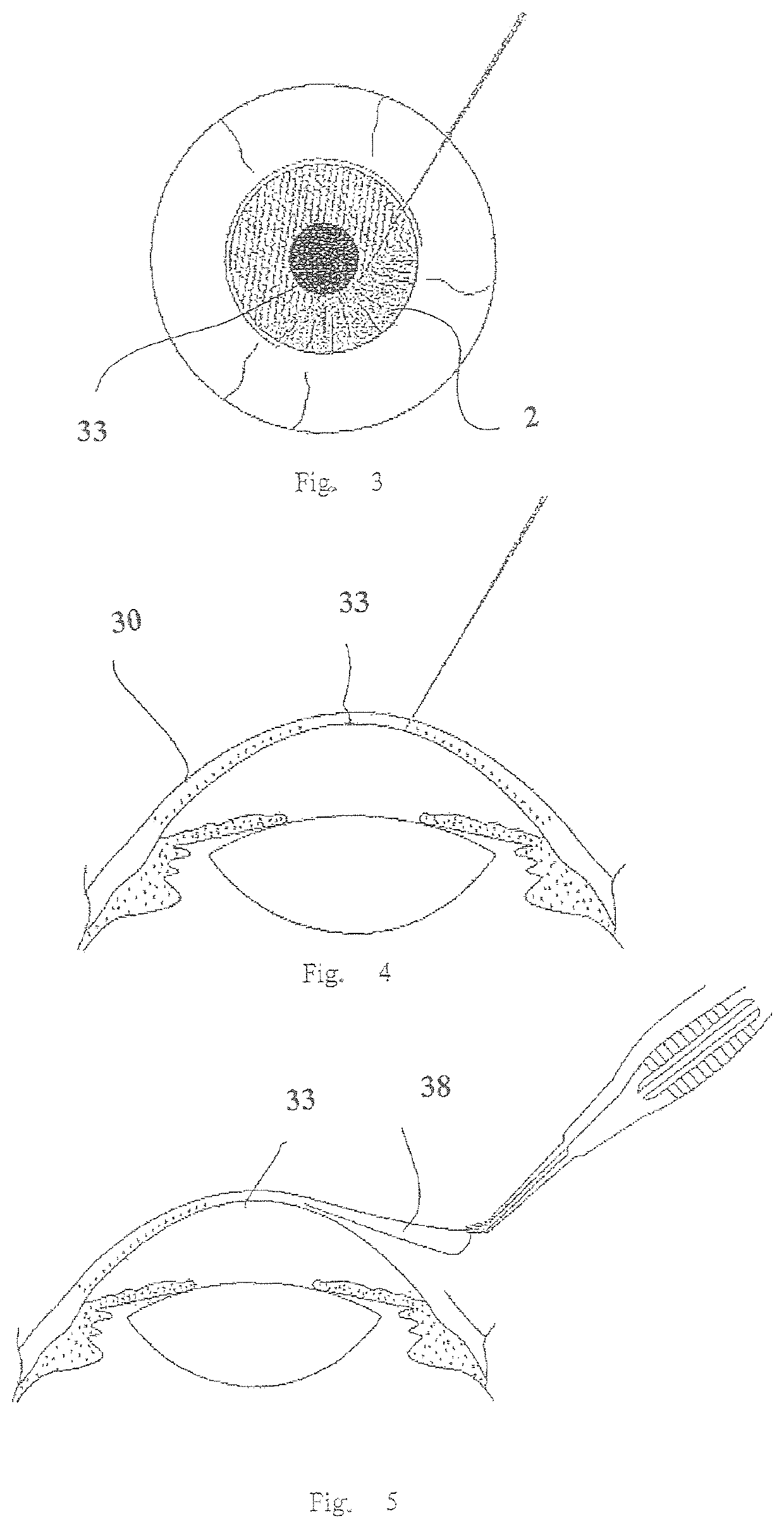 Cosmetic corneal inlay and implantation method thereof