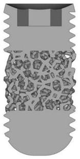 Bone trabecula porous tantalum dental implant and preparation method thereof