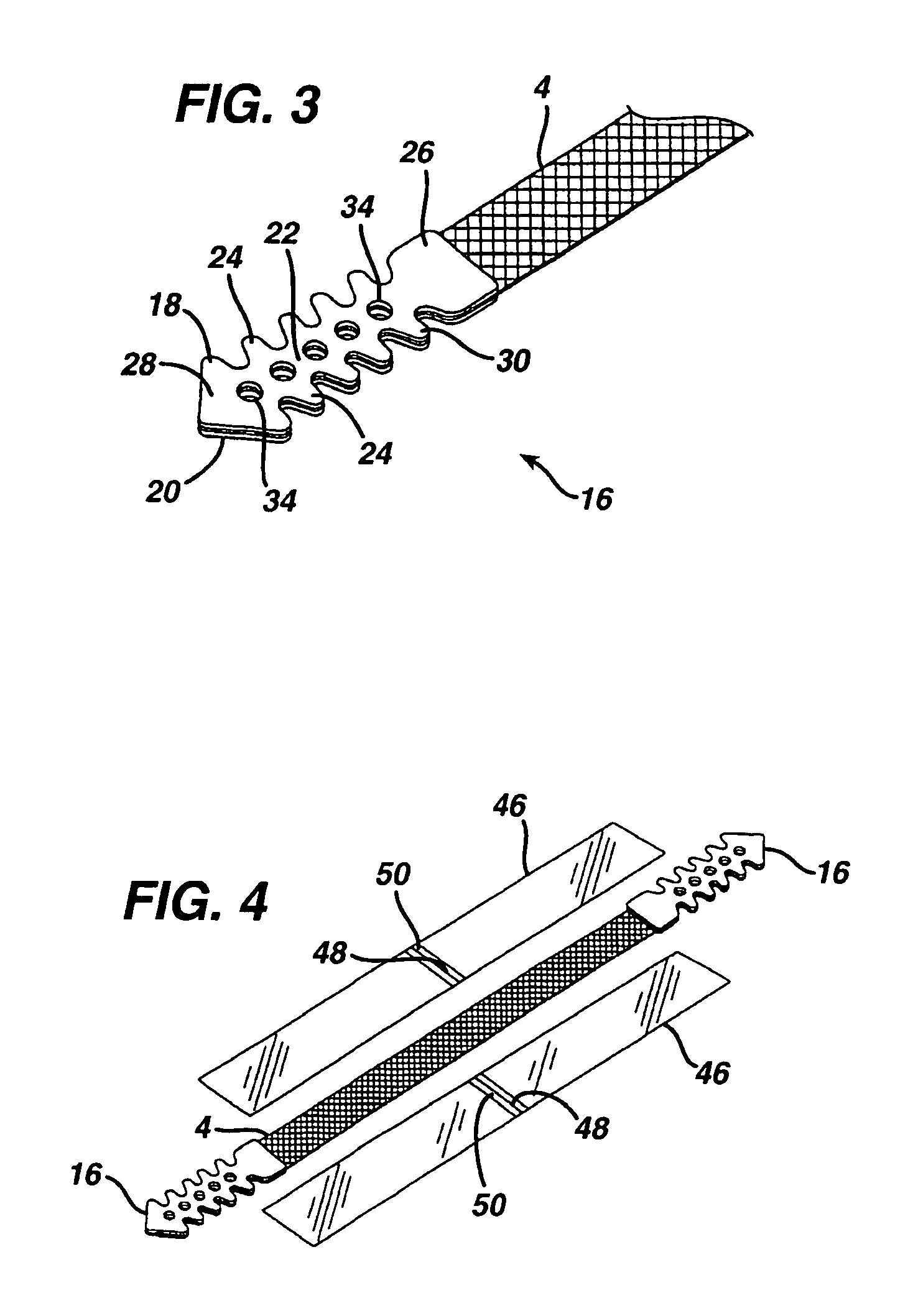 Minimally invasive medical implant and insertion device and method for using the same