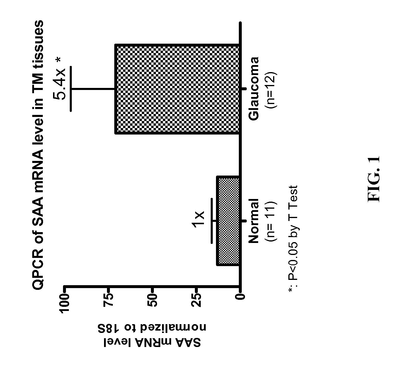 Use of serum amyloid A gene in diagnosis and treatment of glaucoma and identification of anti-glaucoma agents