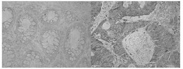 Marker HCCR-1 protein highly expressed in colon cancer tissue and prognostic marker for colon cancer