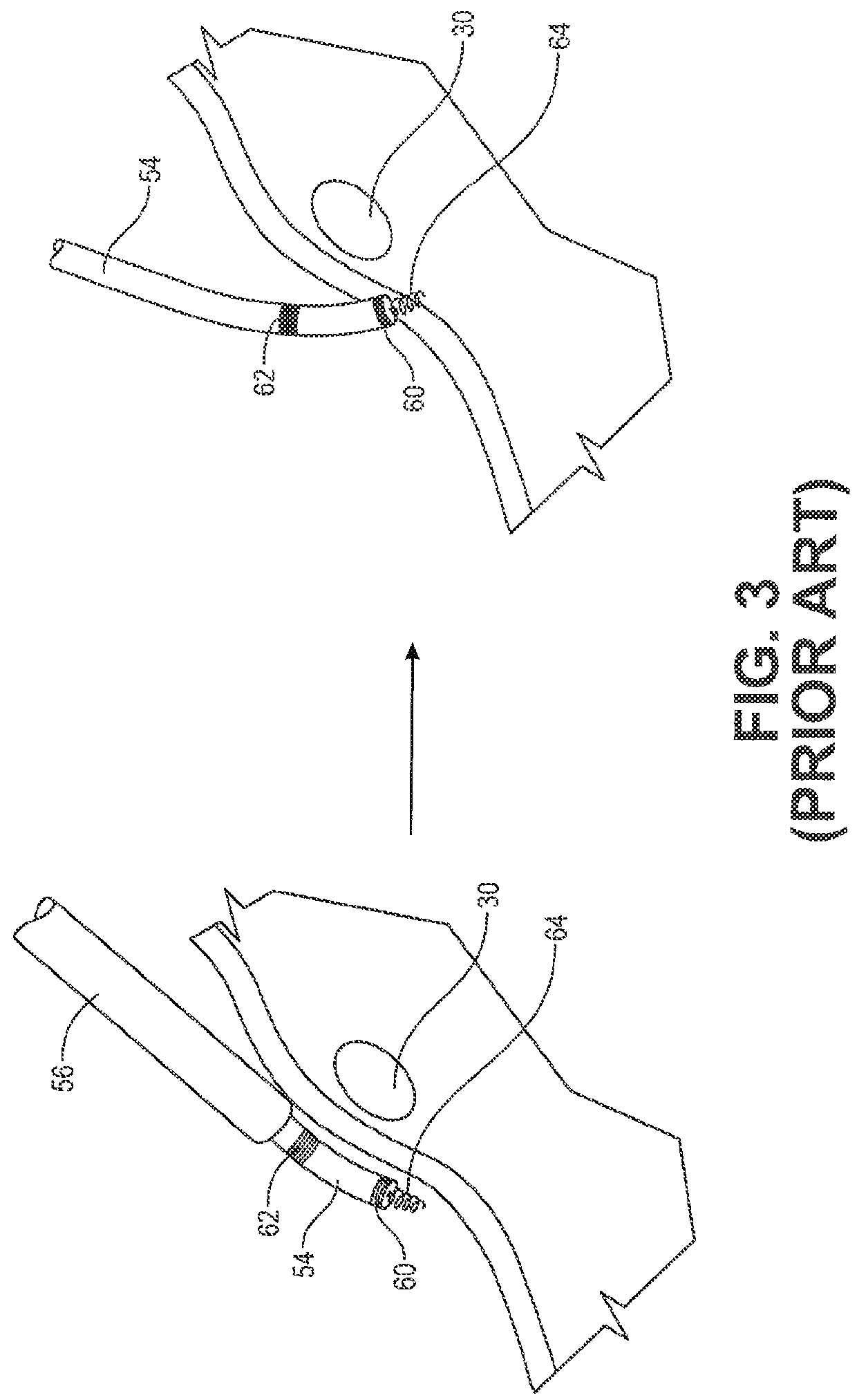 Delivery device having a deflectable and peelable mapping guide sheath for his bundle pacing