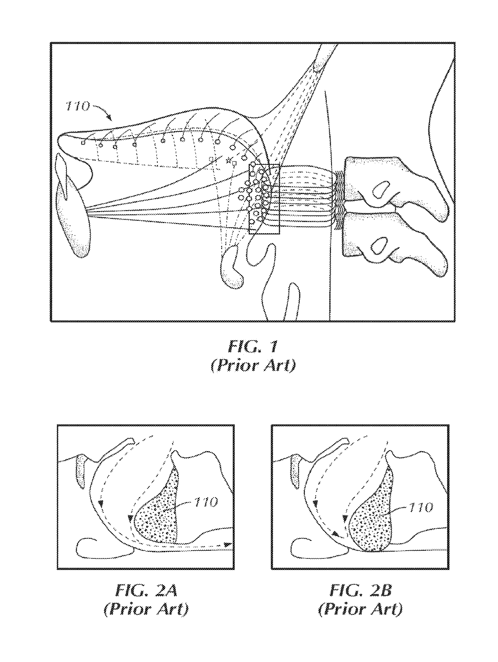 Stimulation of a Hypoglossal Nerve for Controlling the Position of a Patient's Tongue