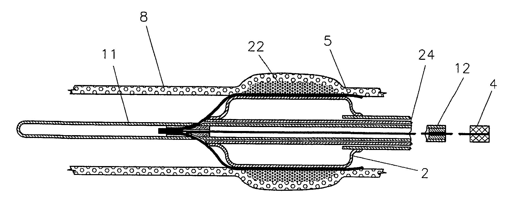 Device and method for converting a balloon catheter into a cutting balloon catheter