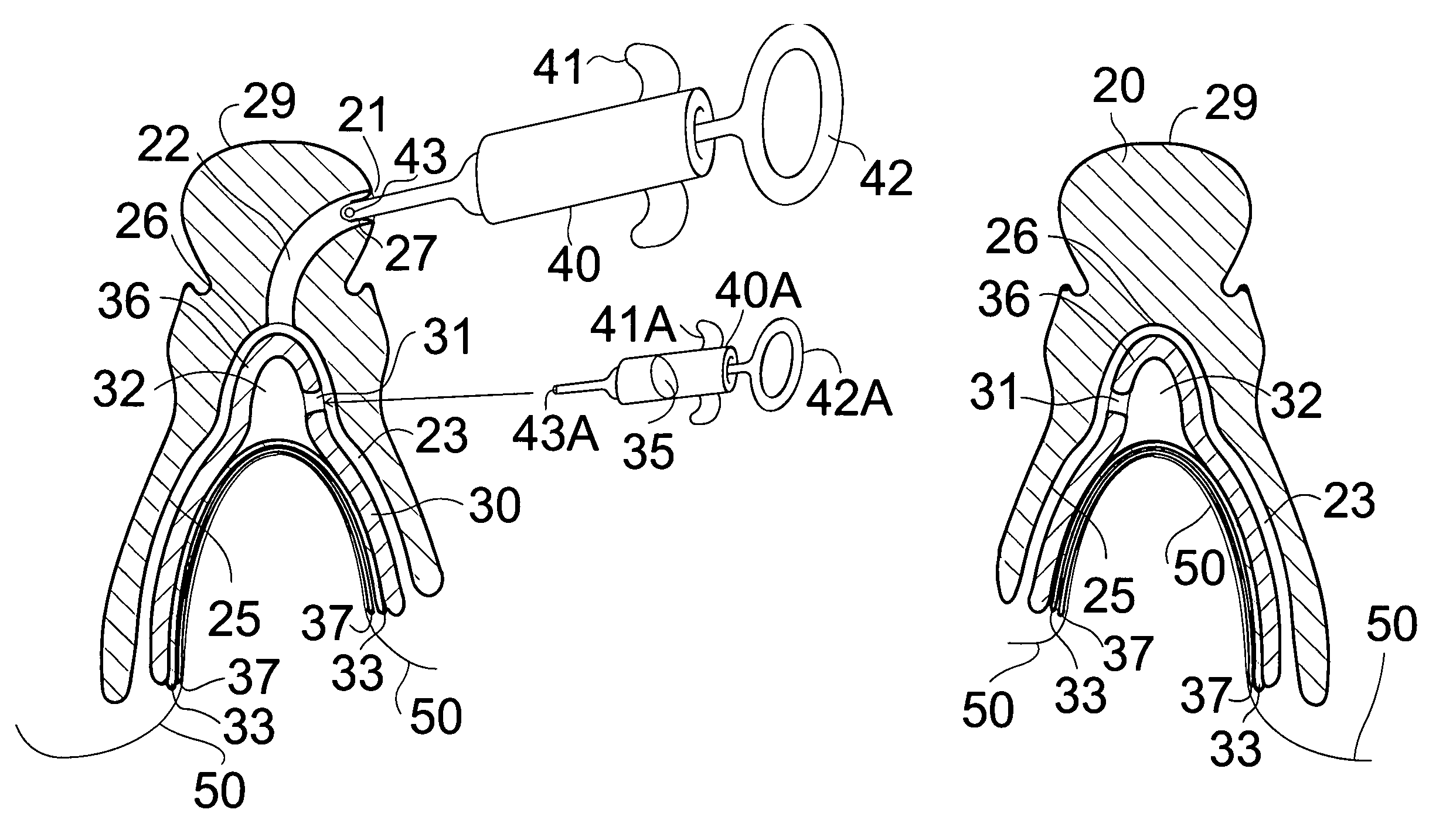 Vacuum-seated dentures with skin contacting plate