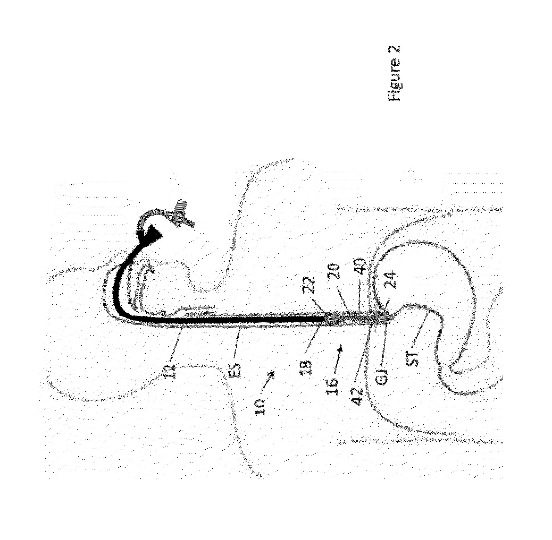 Methods and apparatus for treatment of a body cavity or lumen