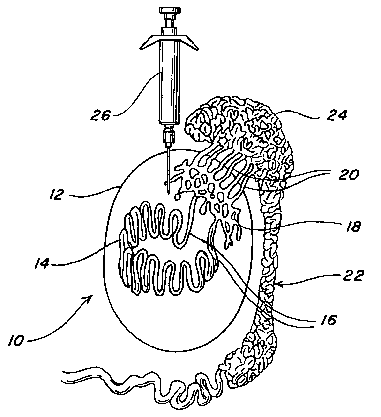 Intratesticular injection of chemical sterilant