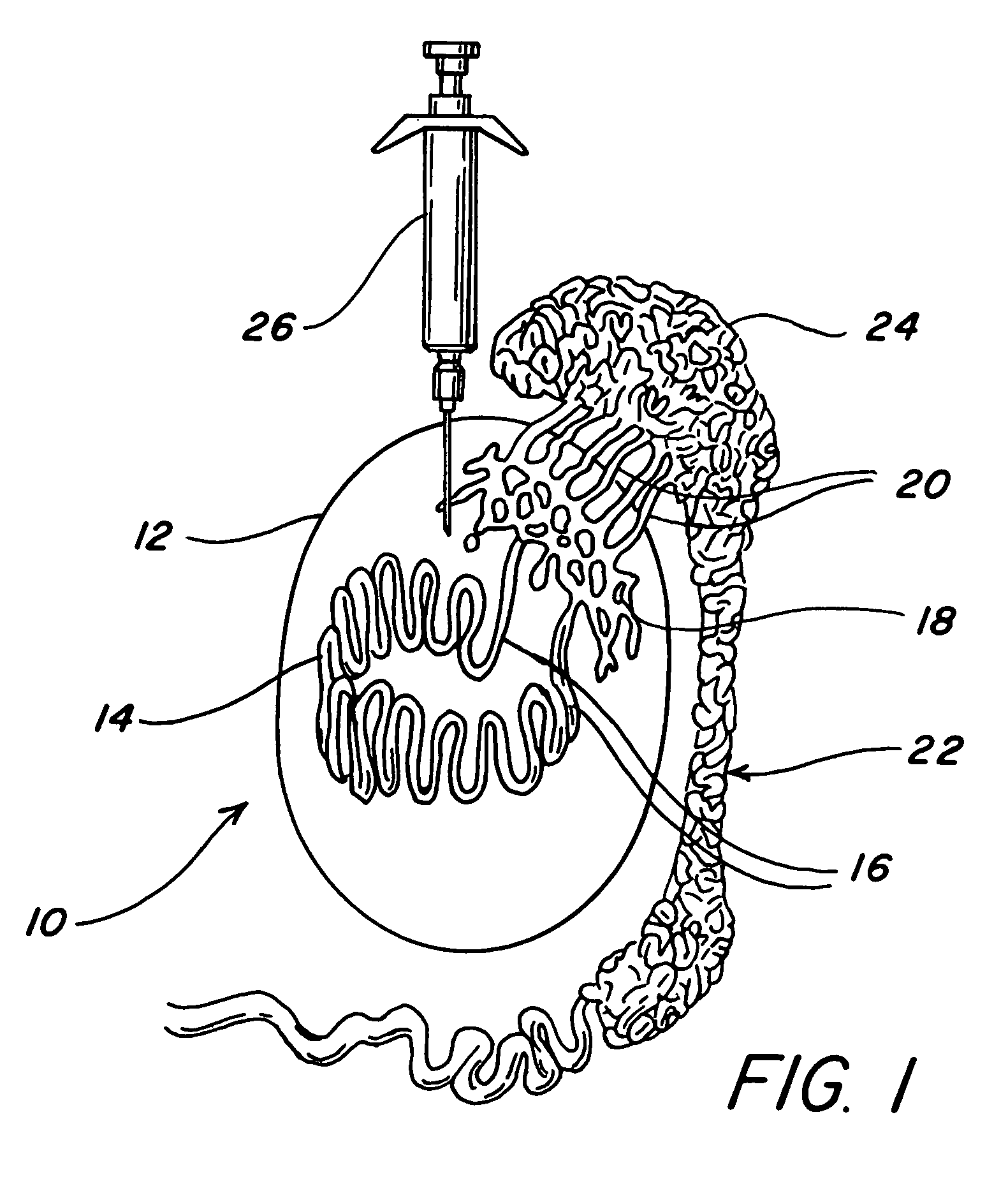 Intratesticular injection of chemical sterilant