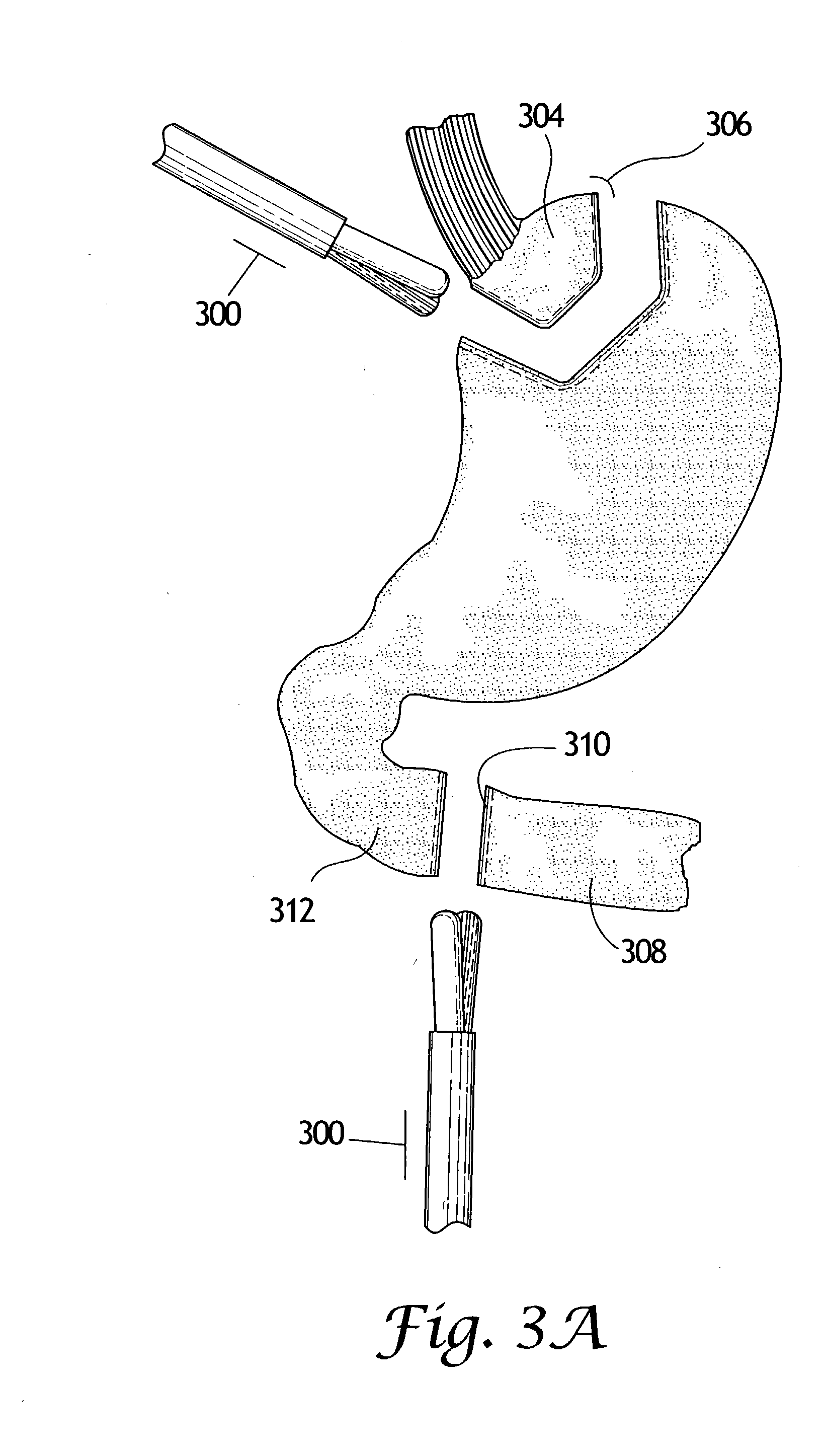 Methods and instrumentation to treat obesity