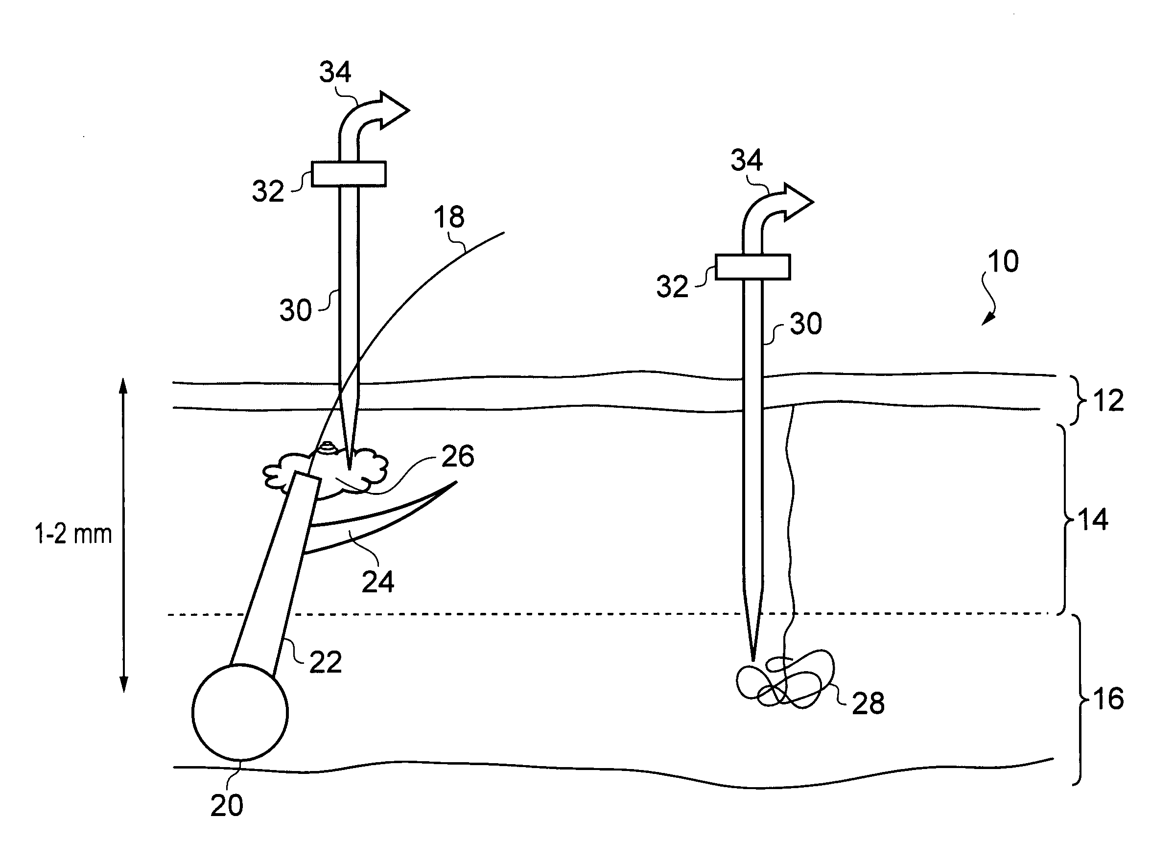 Apparatus for localised invasive skin treatment using electromagnetic radiation